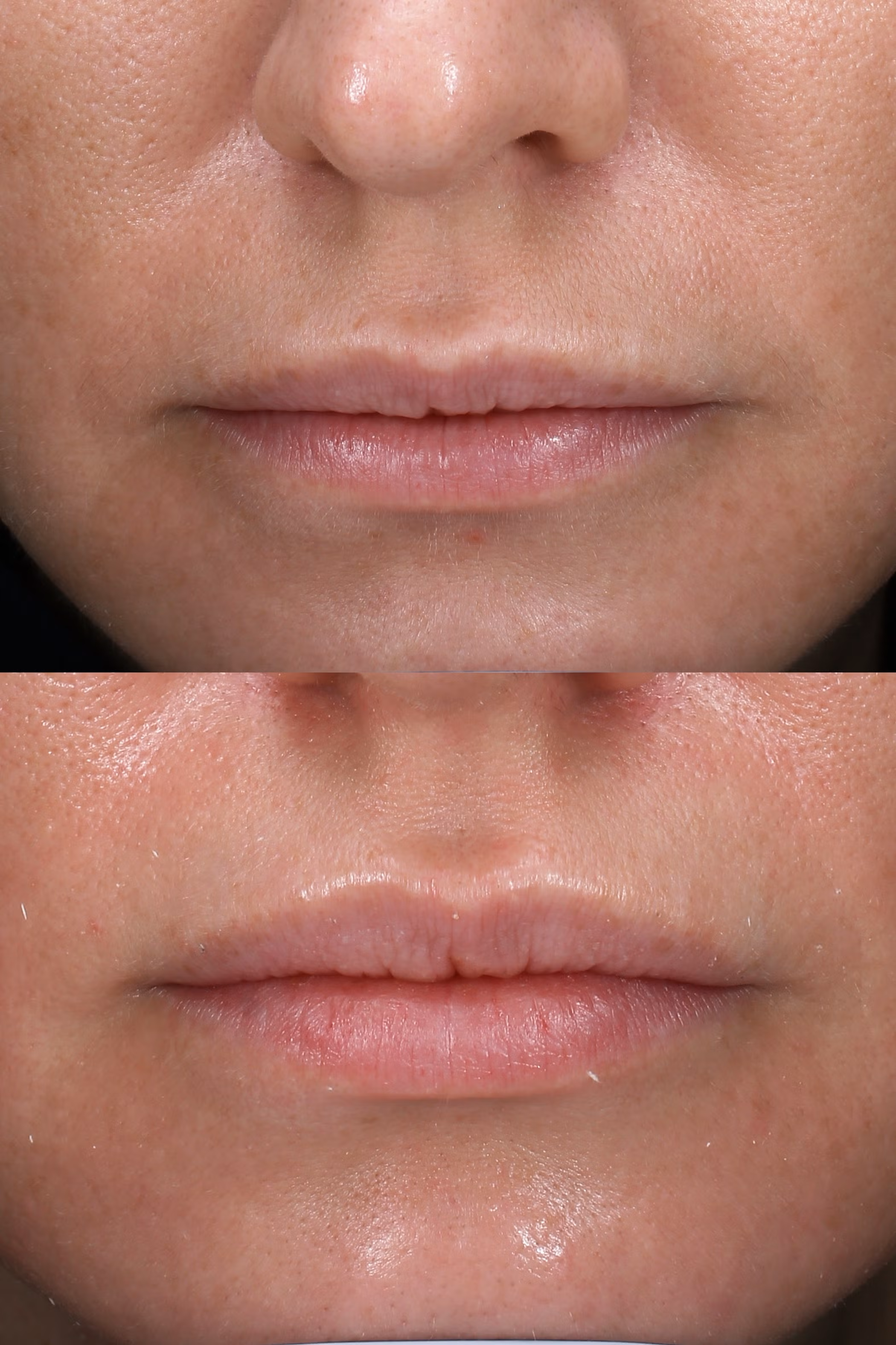 Botox Lip Flip at Rejuvenate Wellness KY.