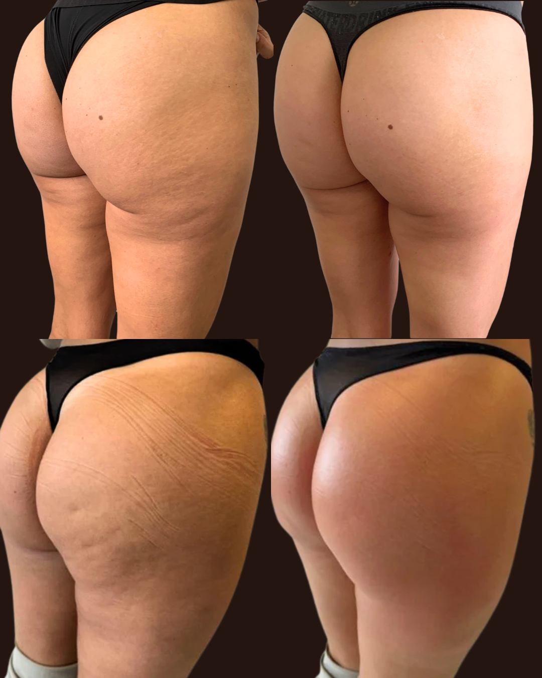 T Shape 2 Body Contouring Cellulite Before and After at Rejuvenate Wellness in Florence, KY