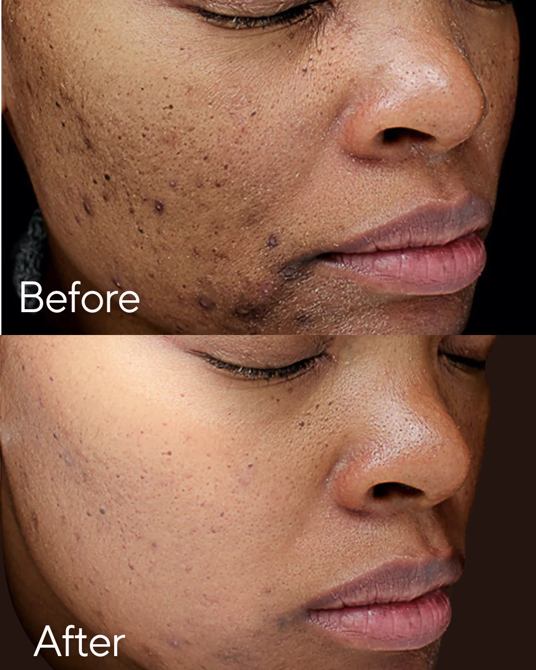 Close-up of a person's face showing a significant reduction in acne scars and skin blemishes in the after photo compared to the before photo at Rejuvenate Wellness in Florence Kentucky