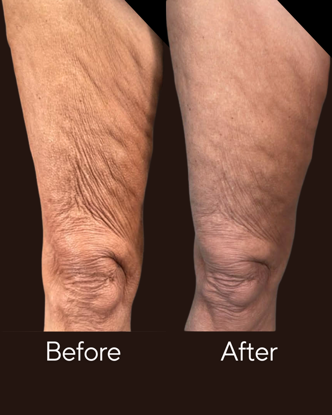 Cellulite Reduction Treatment at Rejuvenate Wellness in Florence KY