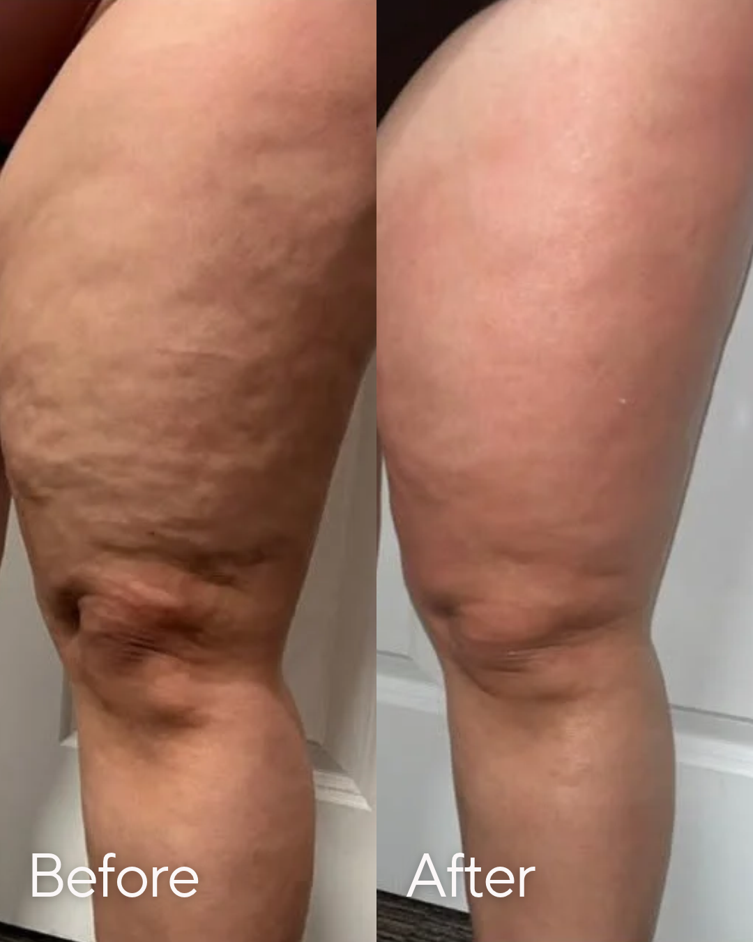 T Shape Cellulite Reduction at Rejuvenate Wellness in Florence KY