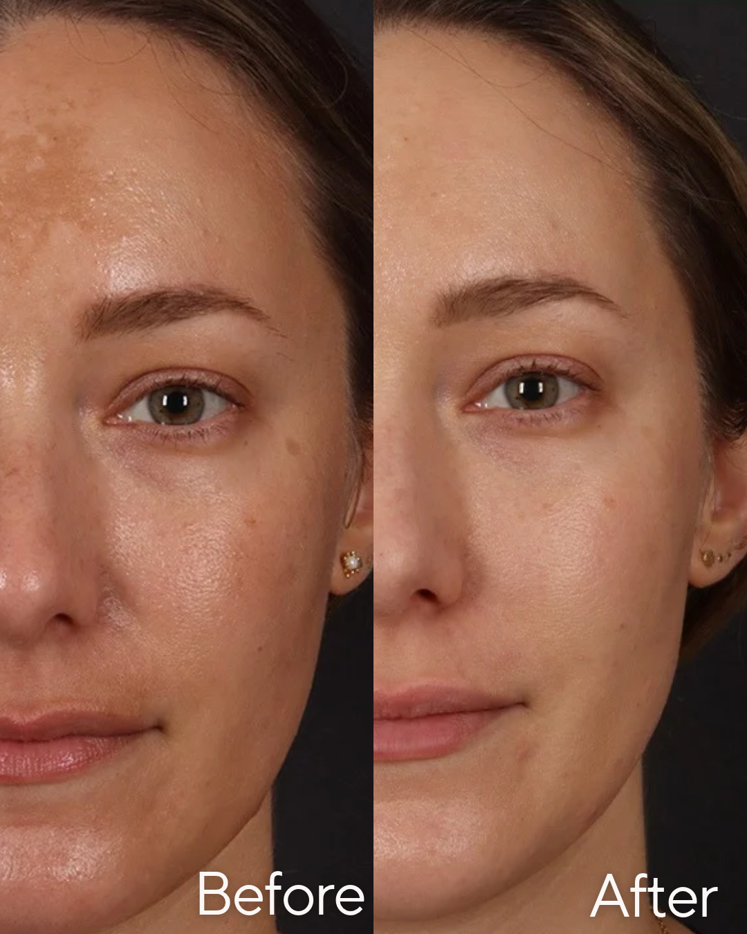 Side-by-side comparison of a woman's face showing skin improvement before and after skincare treatment. The left side shows uneven skin tone and texture, while the right side shows clearer and smoother skin at Rejuvenate Wellness in Florence Kentucky