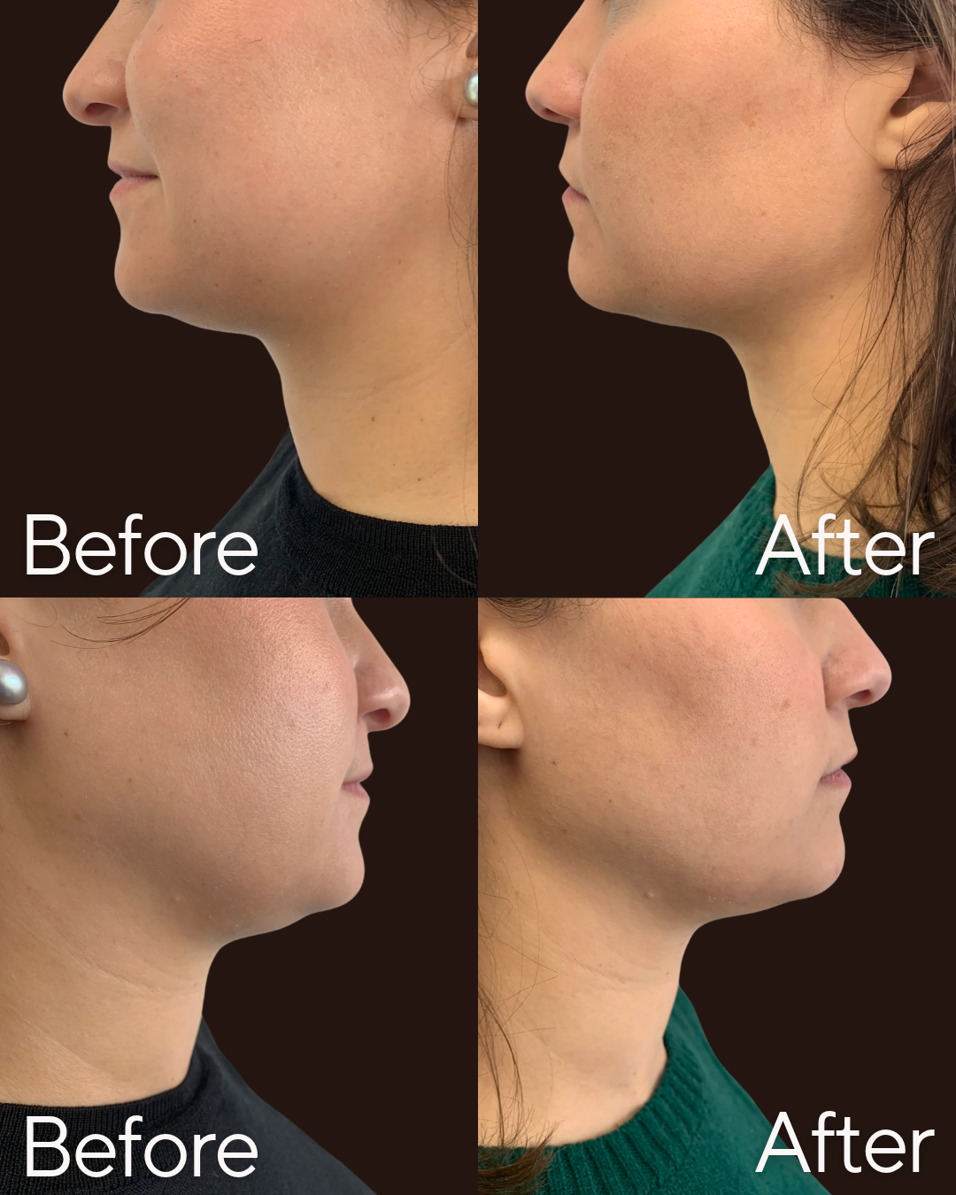 Rejuvenate Wellness T Shape Neck and Jawline treatment in Florence, KY