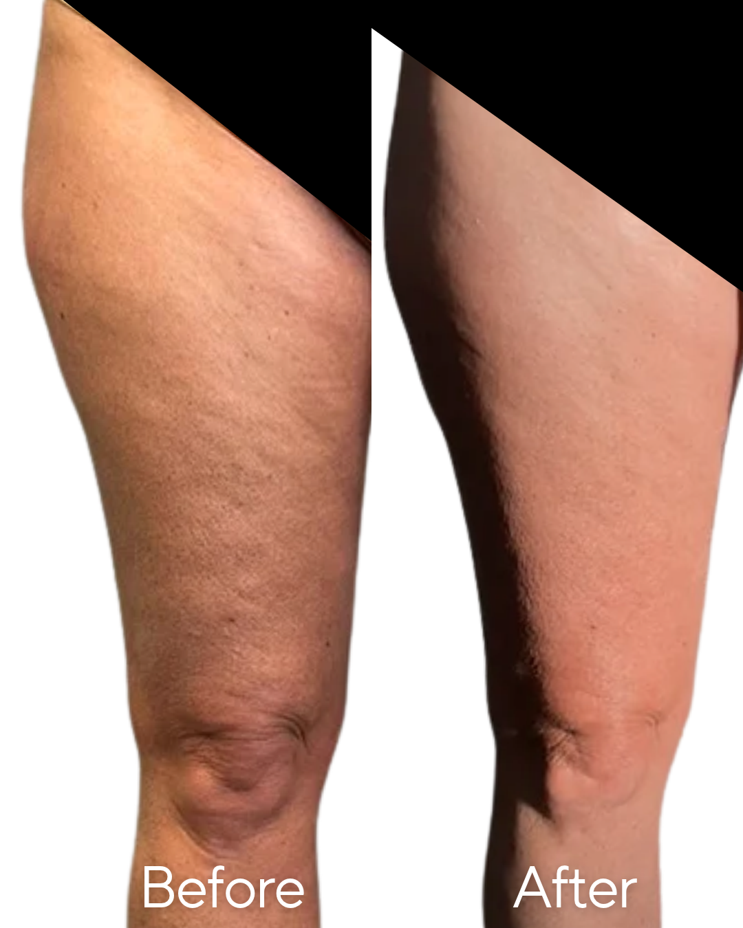 T Shape 2 Cellulite Reduction at Rejuvenate Wellness in Florence KY