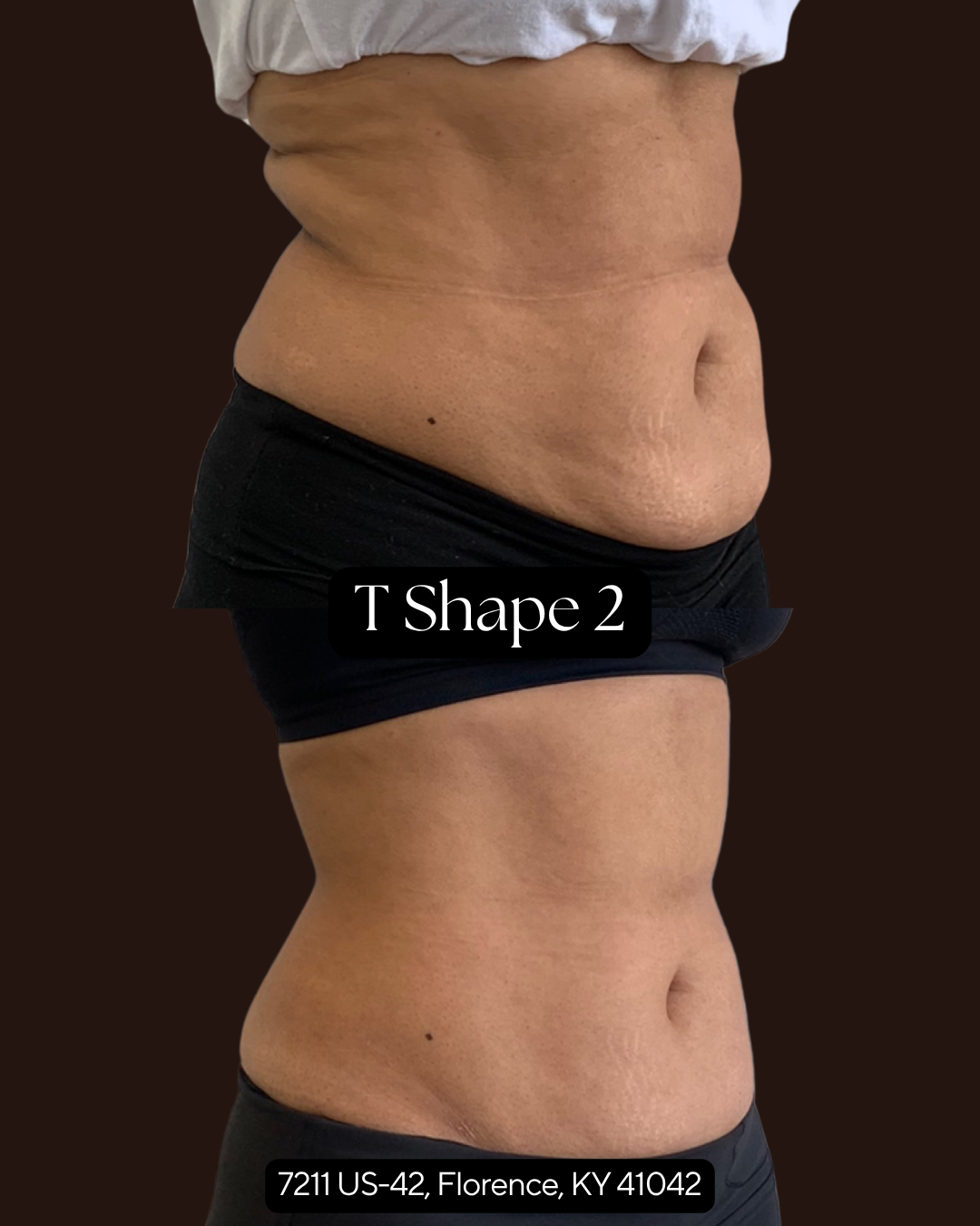 T Shape 2 abdomen body contouring treatment in Florence Kentucky at Rejuvenate Wellness
