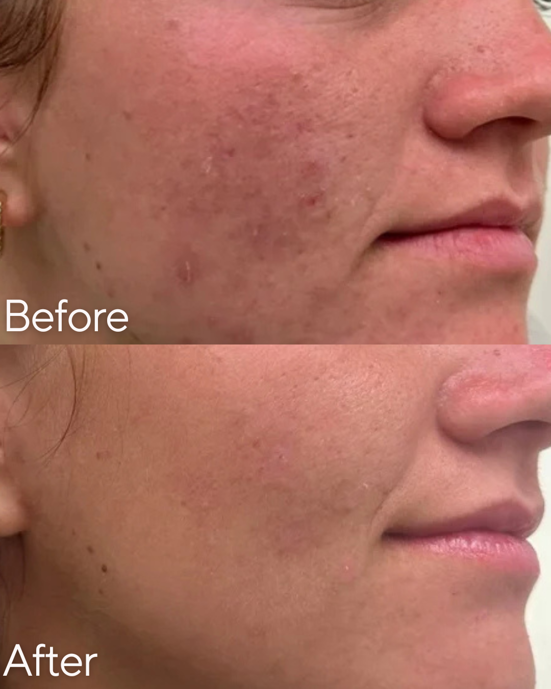 Comparison of a person's cheek before and after skincare treatment showing reduced redness, acne scars, and smoother skin at Rejuvenate Wellness in Florence Kentucky
