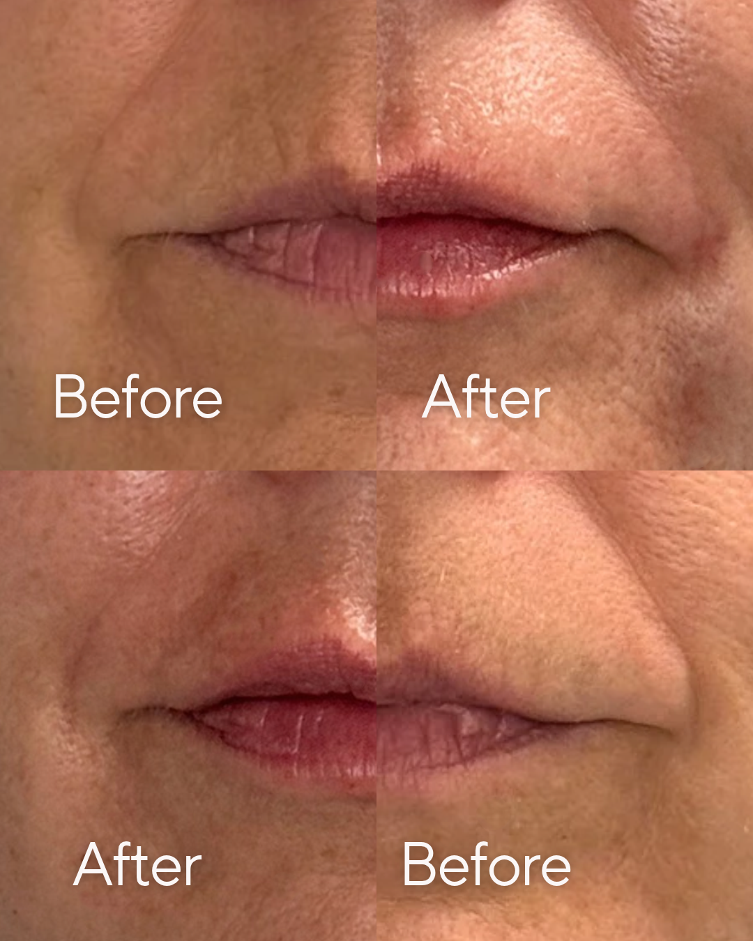 Lip Filler before and after at Rejuvenate Wellness in Florence, KY