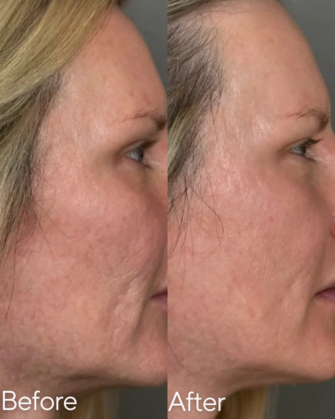 Side-by-side comparison of a woman's face showing improvement in skin texture and appearance from before to after treatment at Rejuvenate Wellness in Florence Kentucky