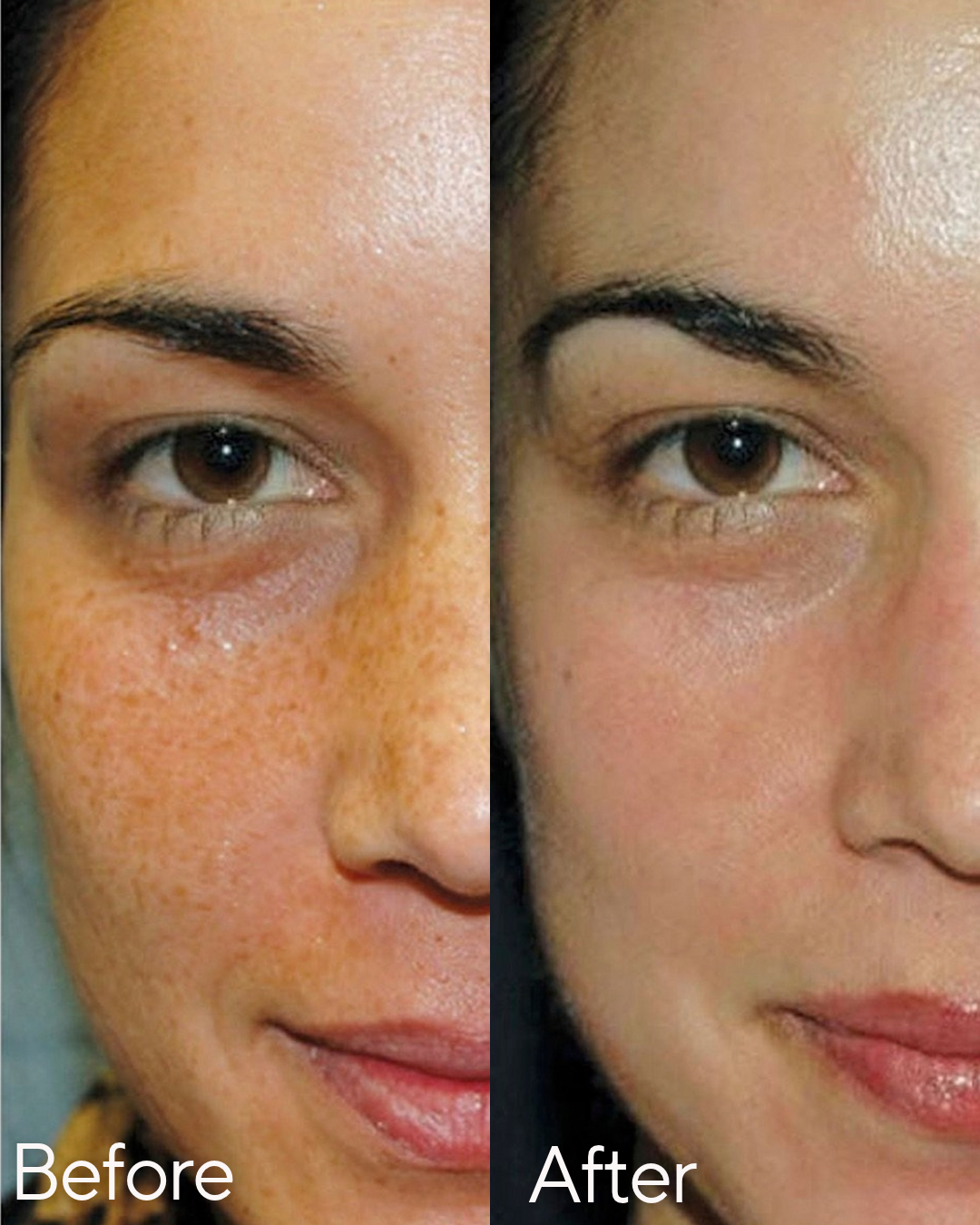 Side-by-side comparison of a woman's face showing skin improvement; the left side labeled 'Before' shows redness and freckles, while the right side labeled 'After' shows clearer skin with fewer blemishes at Rejuvenate Wellness in Florence Kentucky