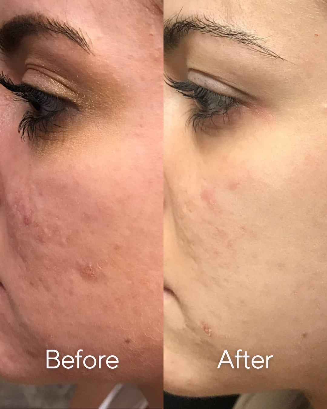 Comparison of a person's cheek before and after skincare treatment showing improved skin texture and reduced acne at Rejuvenate Wellness in Florence Kentucky