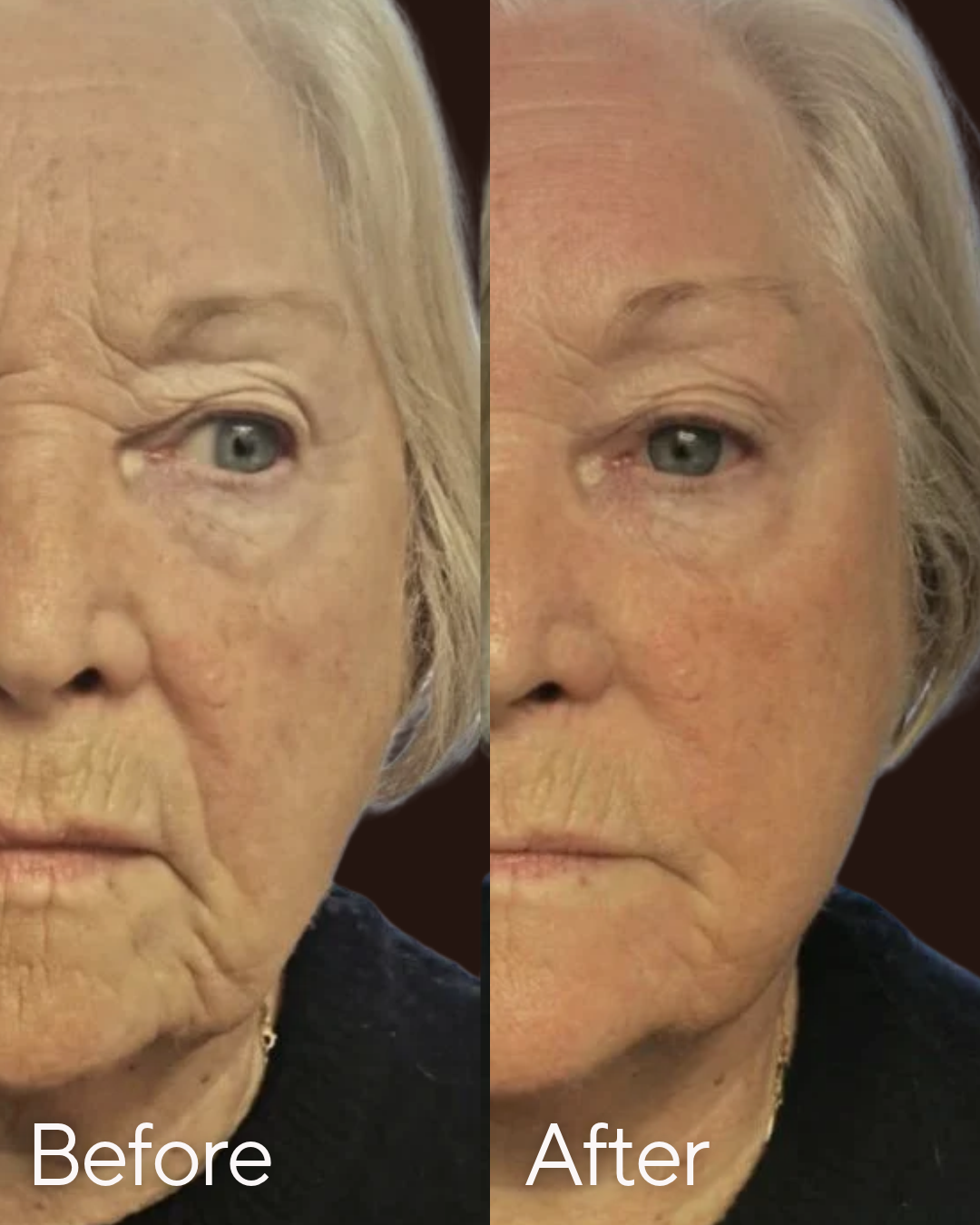 T Shape Face Treatment at Rejuvenate Wellness in Florence KY