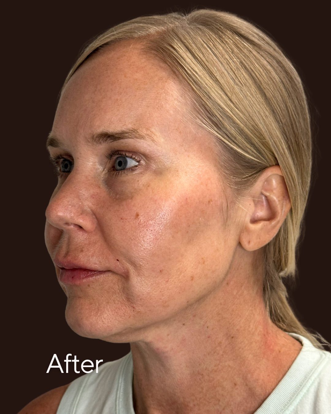 Dermal Filler After Image Side Profile at Rejuvenate Wellness in Florence KY
