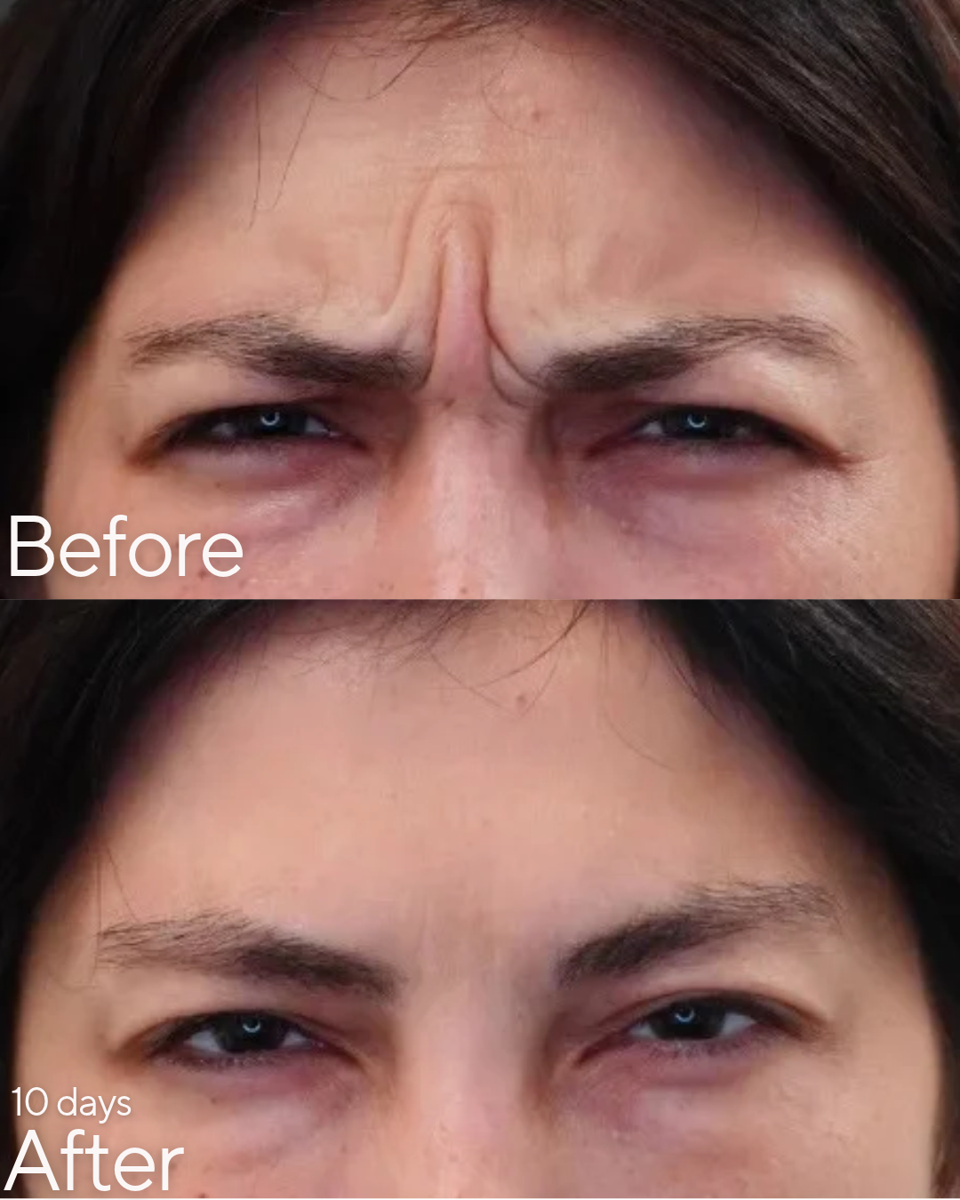 XEOMIN at Rejuvenate Wellness in Florence, Kentucky