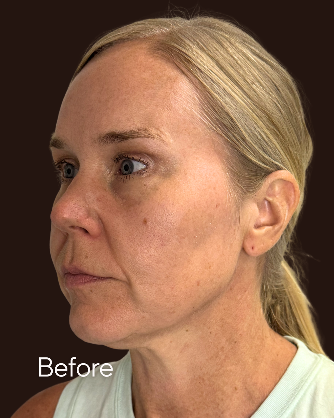 Dermal Filler Before Image Side Profile at Rejuvenate Wellness in Florence KY