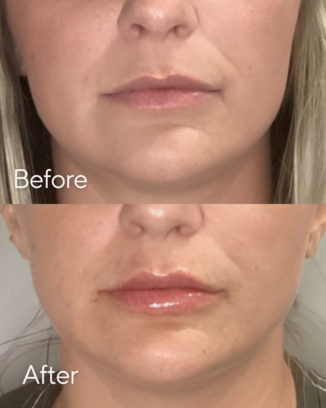 Lip Filler at Rejuvenate Wellness in Florence, KY