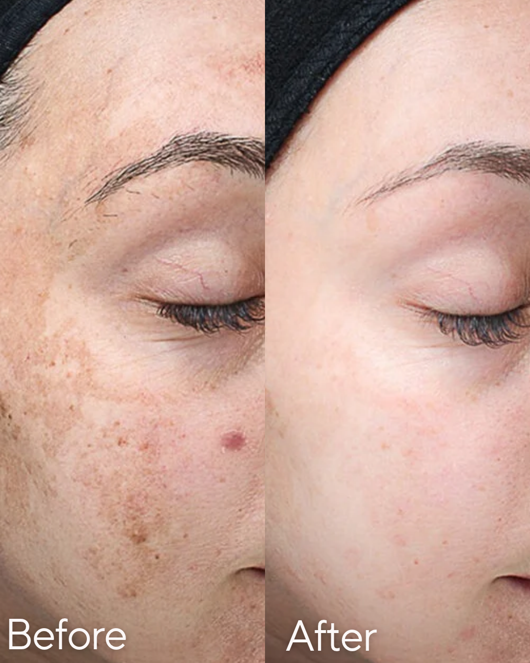 Side-by-side comparison of a woman's face showing before and after skin treatment. The before side has acne, dark spots, and uneven skin tone, while the after side has clear, smooth, and even skin at Rejuvenate Wellness in Florence Kentucky