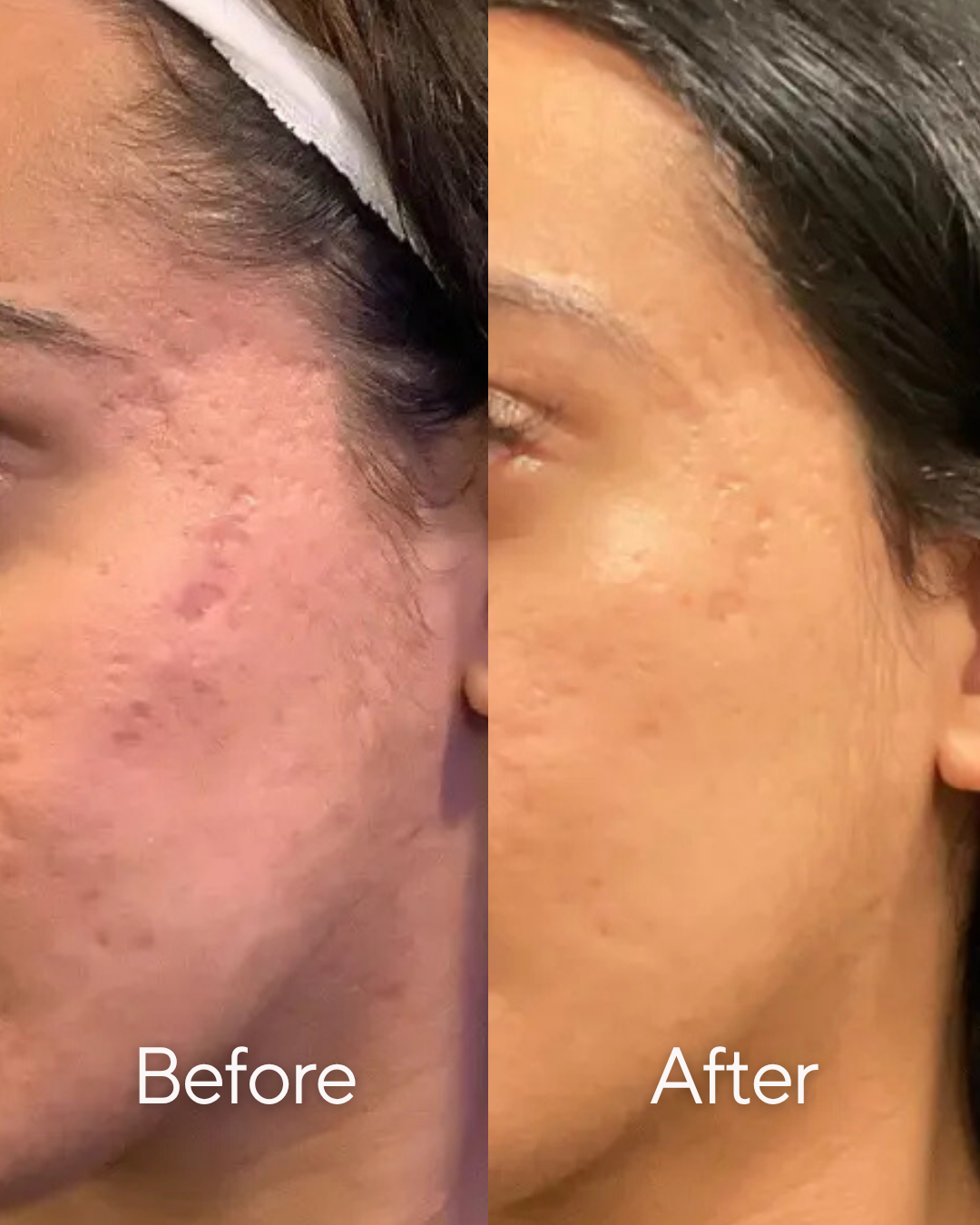Side-by-side comparison of a woman's face showing skin improvement. The 'Before' side has acne scars and hyperpigmentation, while the 'After' side shows clearer, smoother skin at Rejuvenate Wellness in Florence Kentucky