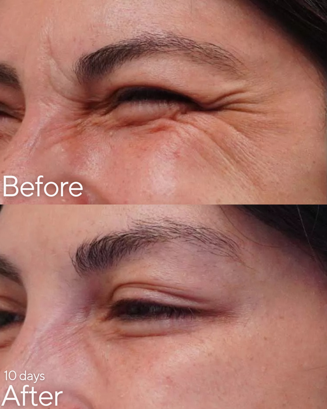 Botox at Rejuvenate Wellness in Florence, KY