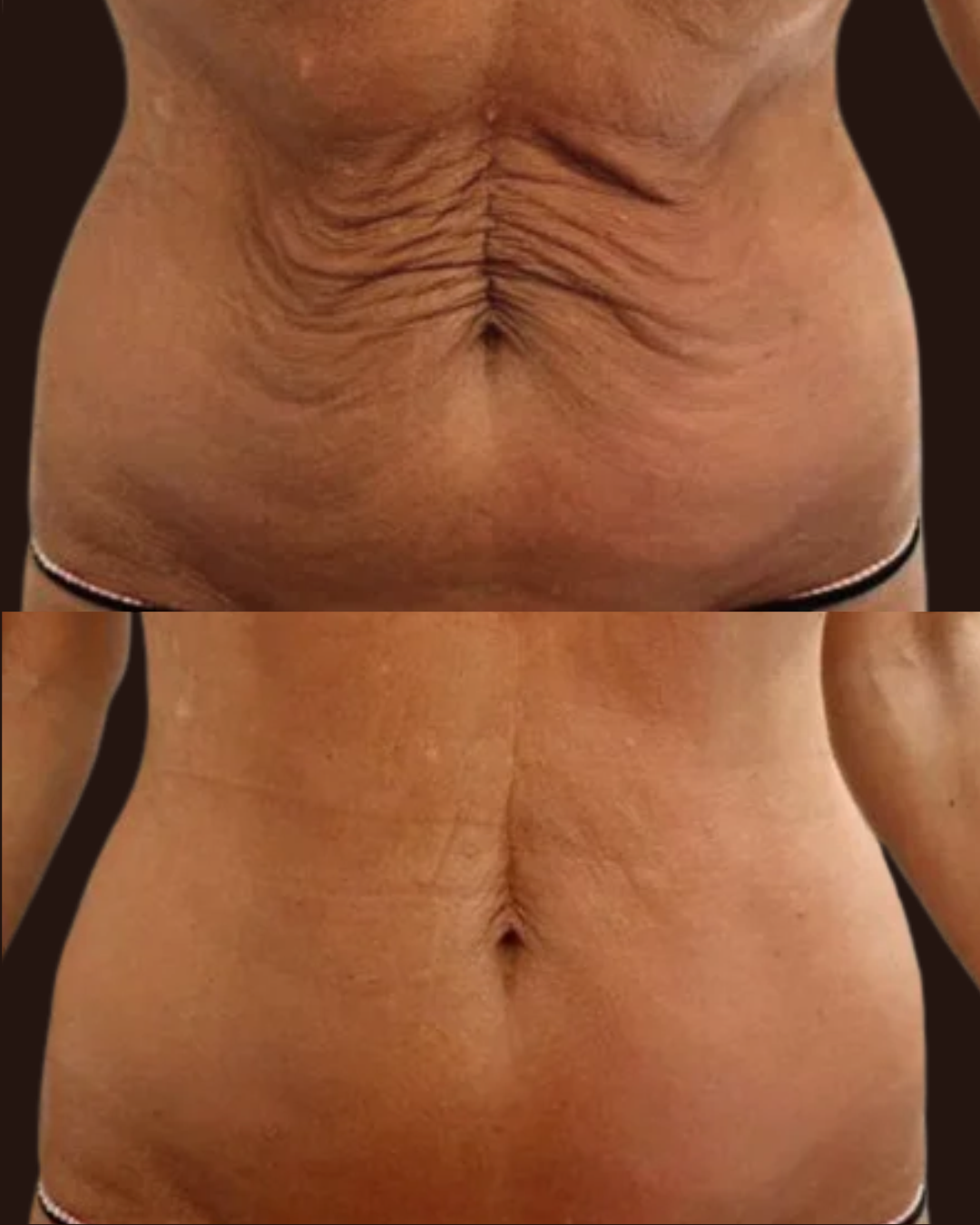 T Shape Body Before and After