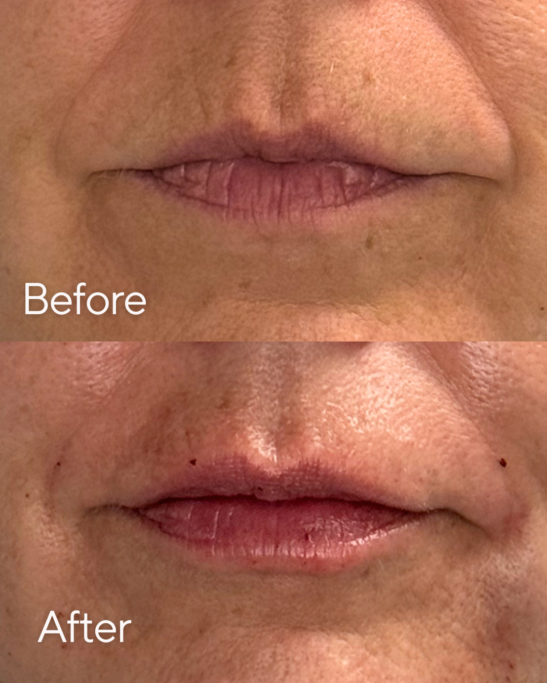 Close-up of a person's lips before and after treatment, showing smoother, more moisturized lips in the after image at Rejuvenate Wellness in Florence Kentucky