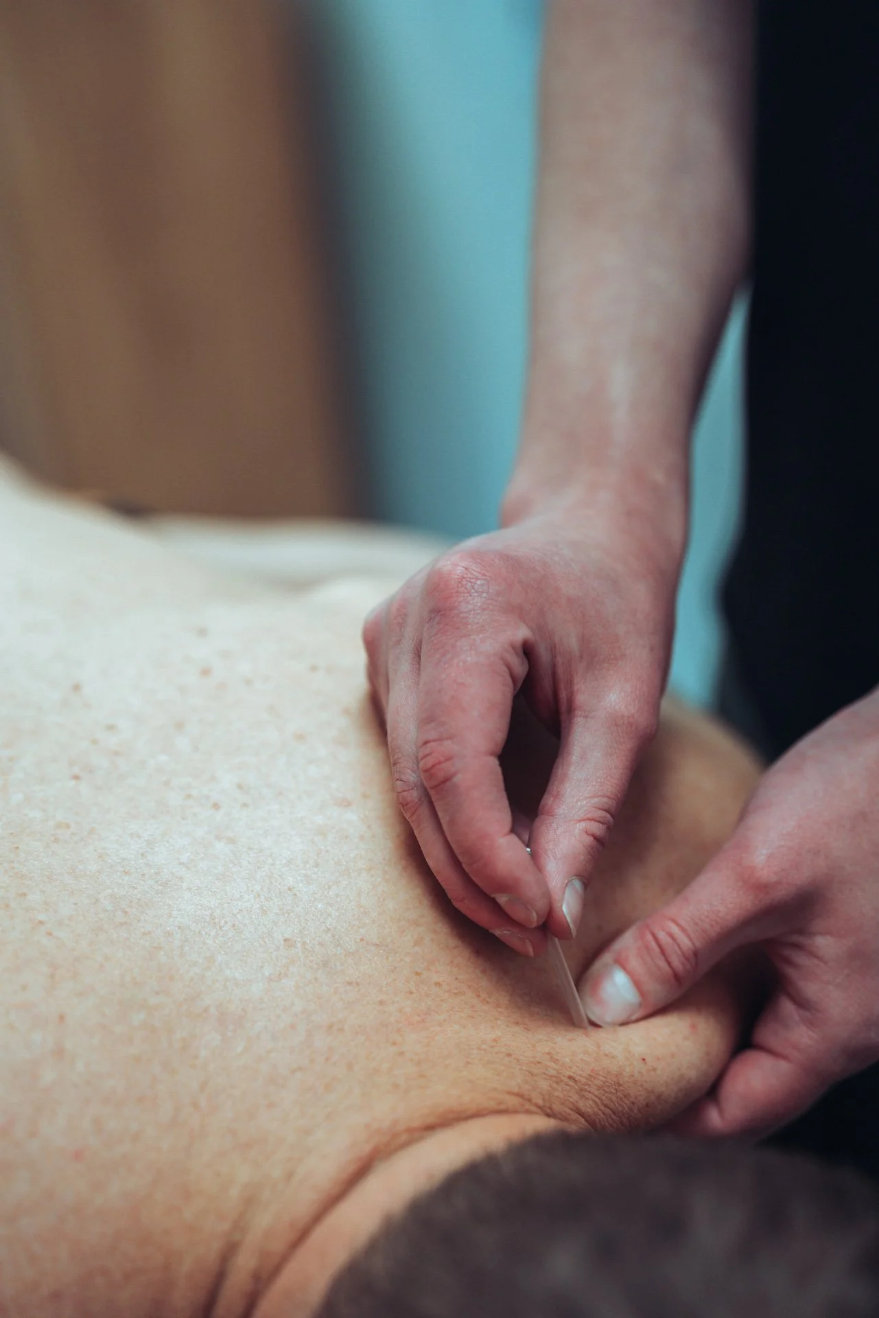 A person receiving acupuncture treatment, with a physio inserting an acupuncture needle into their upper trap