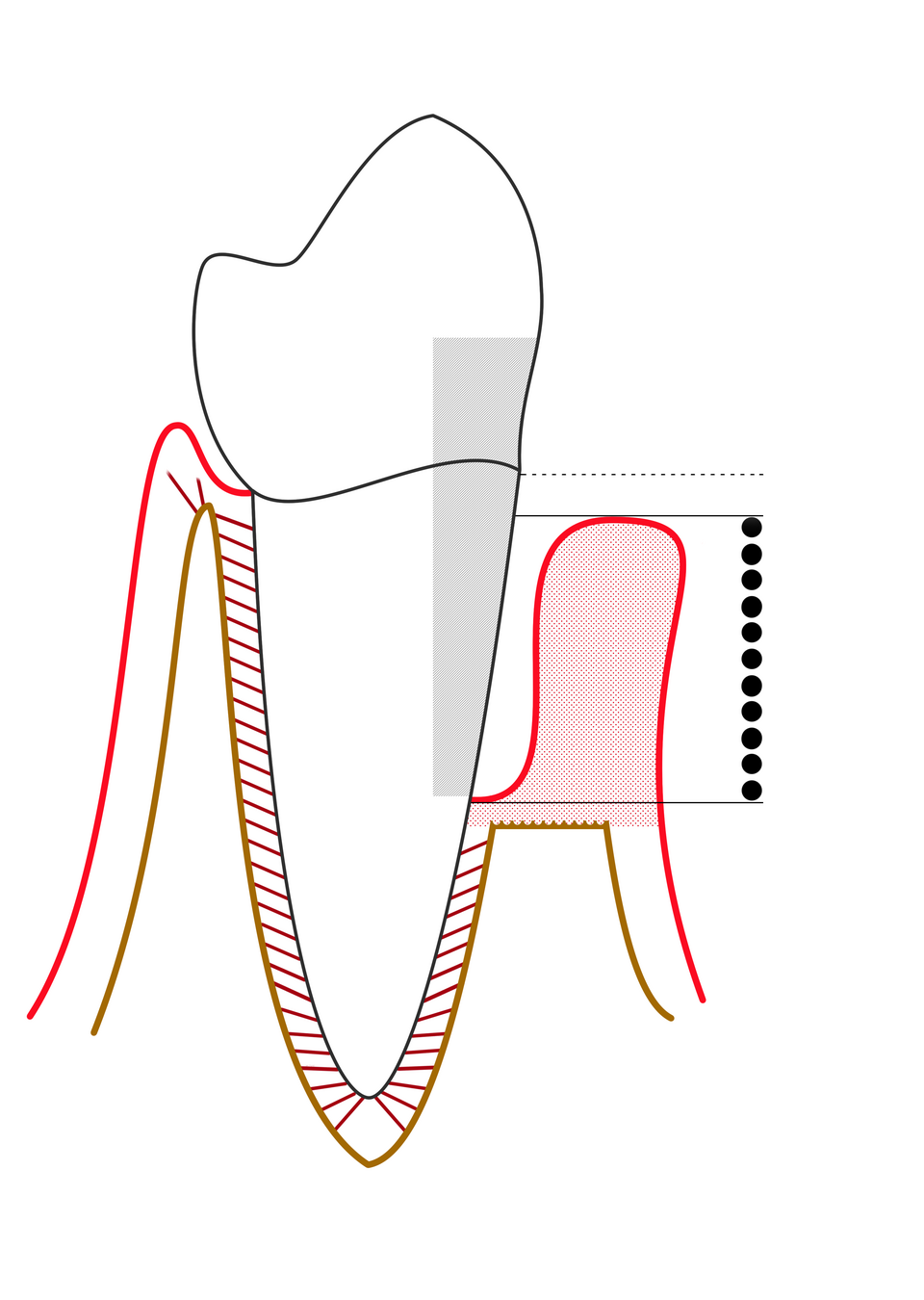 Diagram of severe periodontitis with a deep gum pocket and extensive loss of supporting bone around the tooth