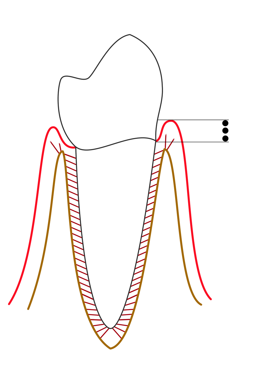 Diagram of a healthy tooth with gums and bone; the gum pocket is 1-3 mm deep and the bone level is normal