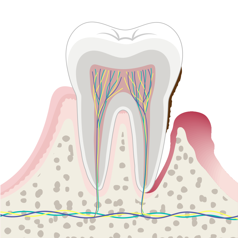 Illustration of periodontal disease showing tartar, a deep gum pocket and bone loss
