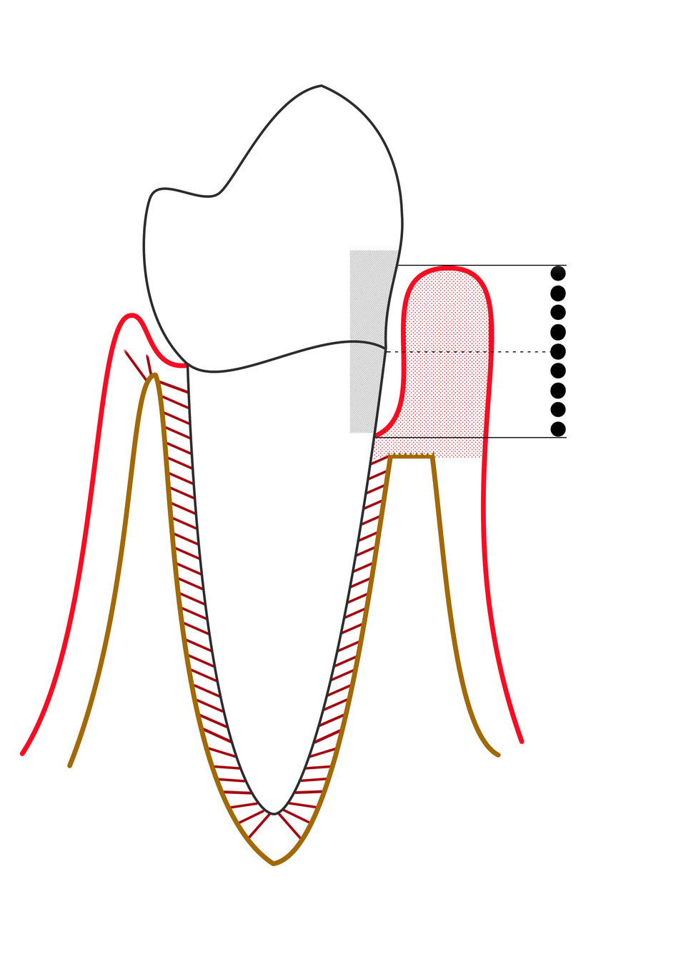 Diagram of moderate periodontitis with a deeper gum pocket and noticeable loss of supporting bone