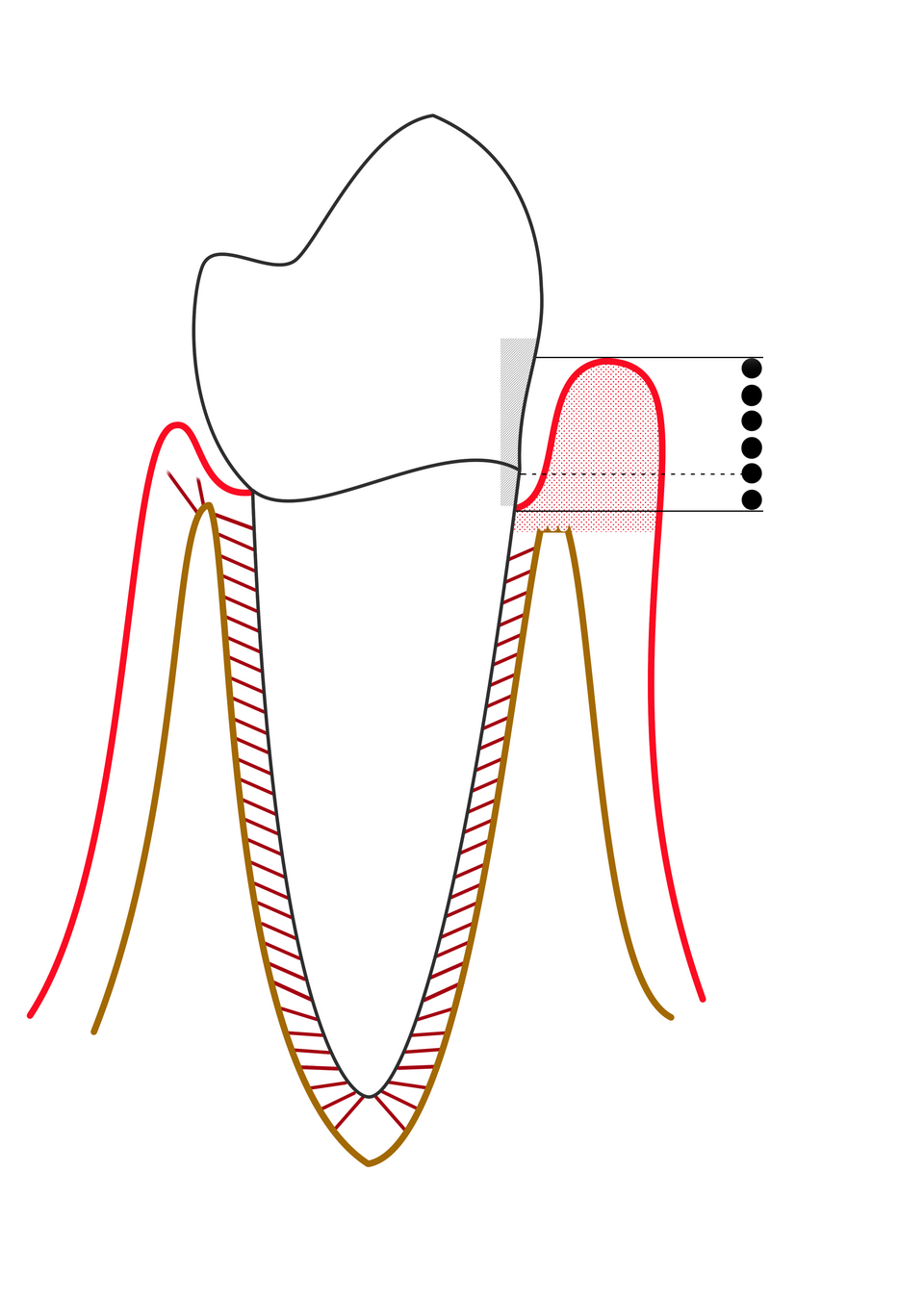 Diagram of mild periodontitis with a slightly deepened gum pocket and early loss of supporting bone