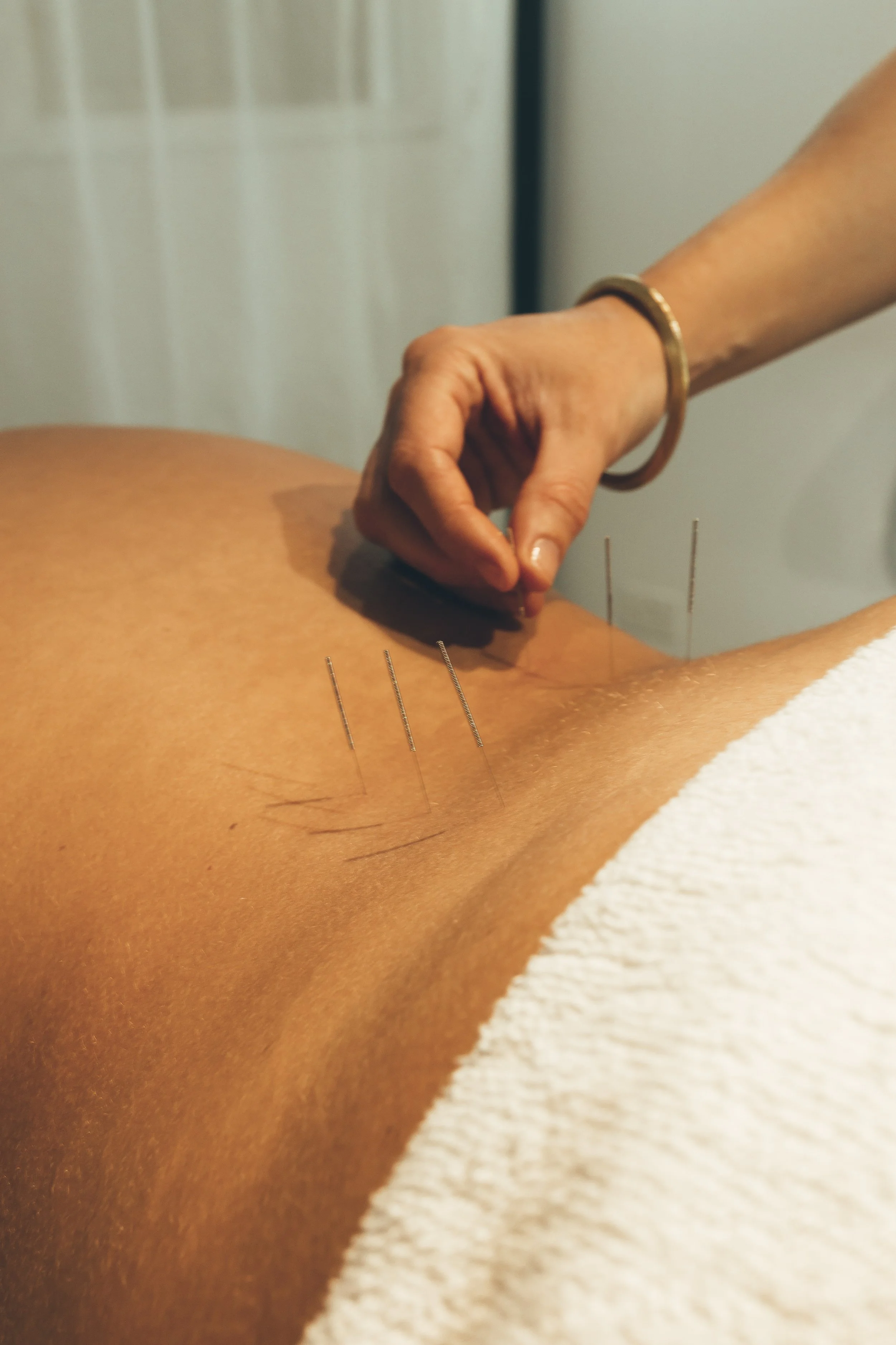 Practitioner inserting acupuncture needles into a person's back during a treatment session.