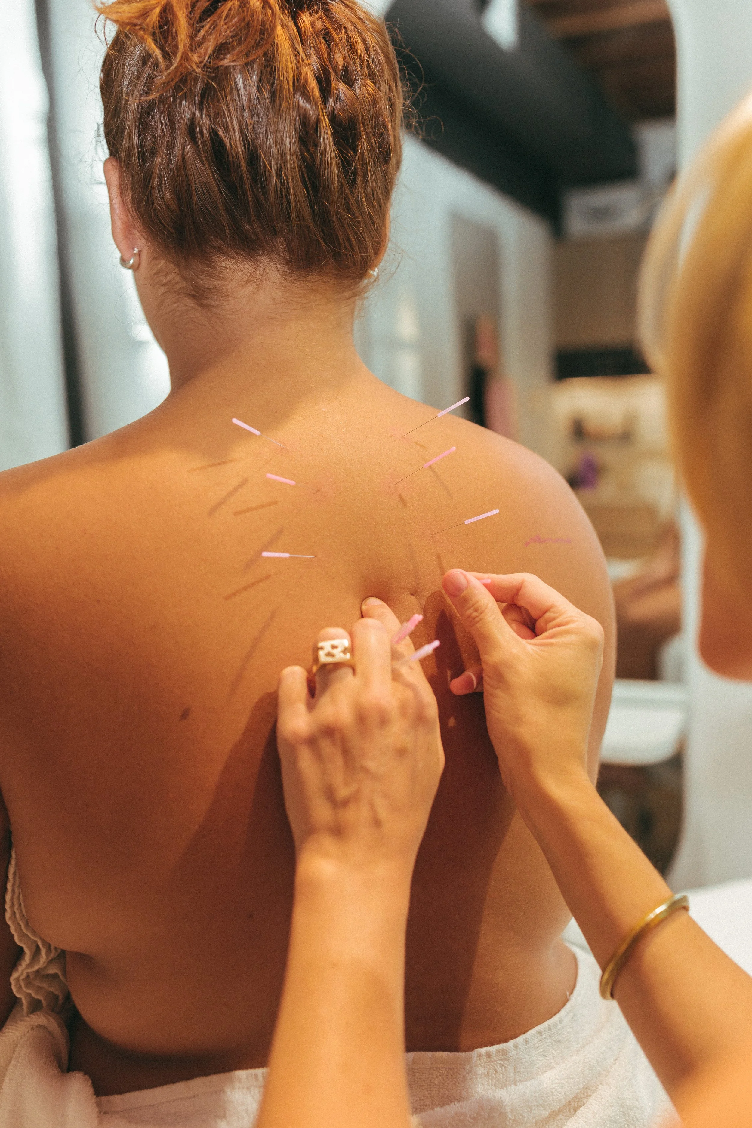 A person is receiving an acupuncture treatment on their upper back and shoulder area. Several thin acupuncture needles are inserted into the person's skin.