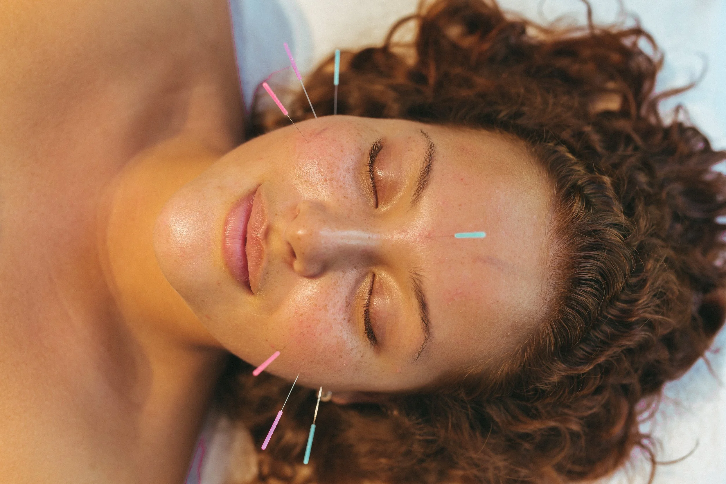 A woman with curly hair lying down with her eyes closed, receiving acupuncture treatment with colorful needles on her face.