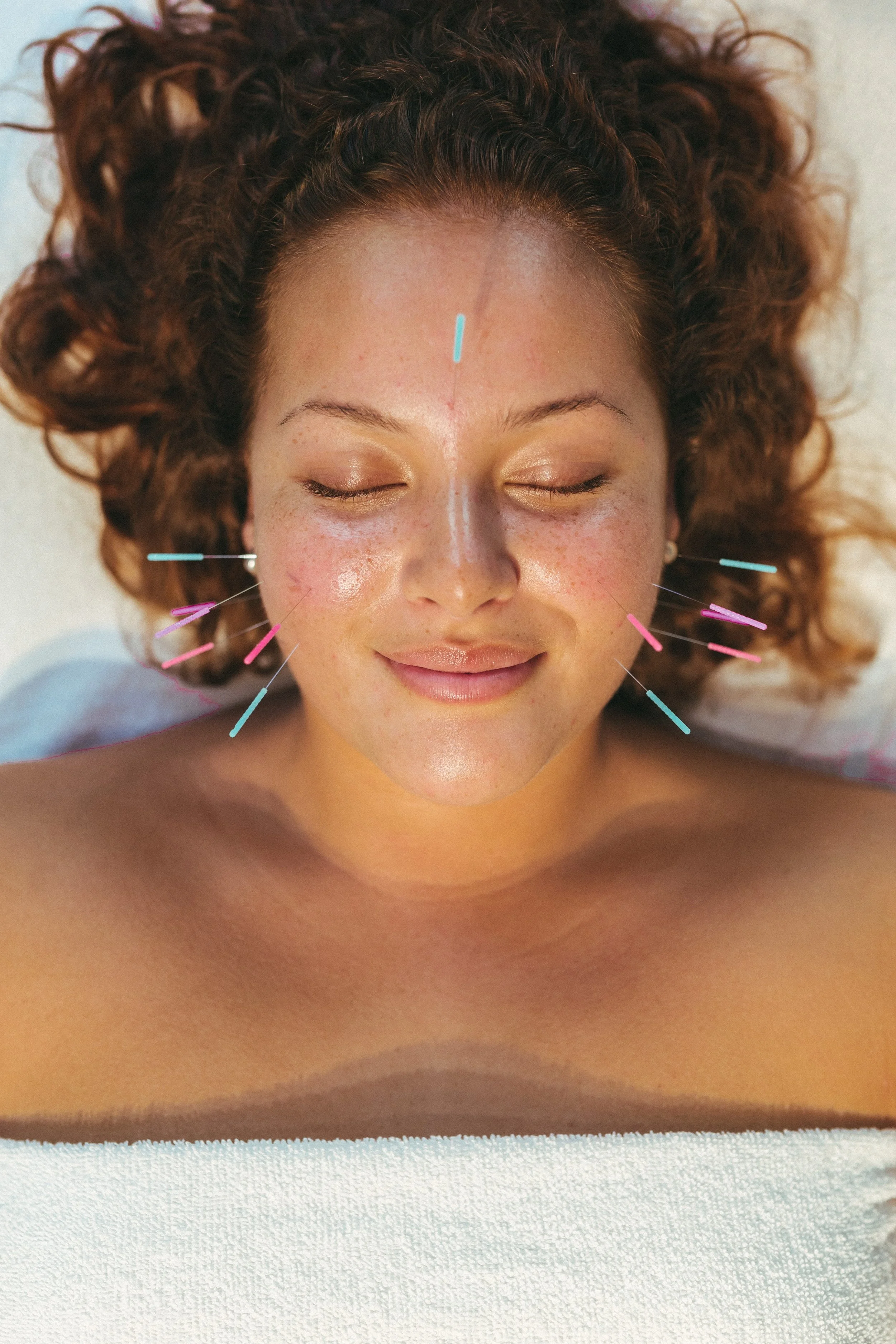 A woman with curly brown hair lying down with her eyes closed, receiving acupuncture treatments on her face and head.