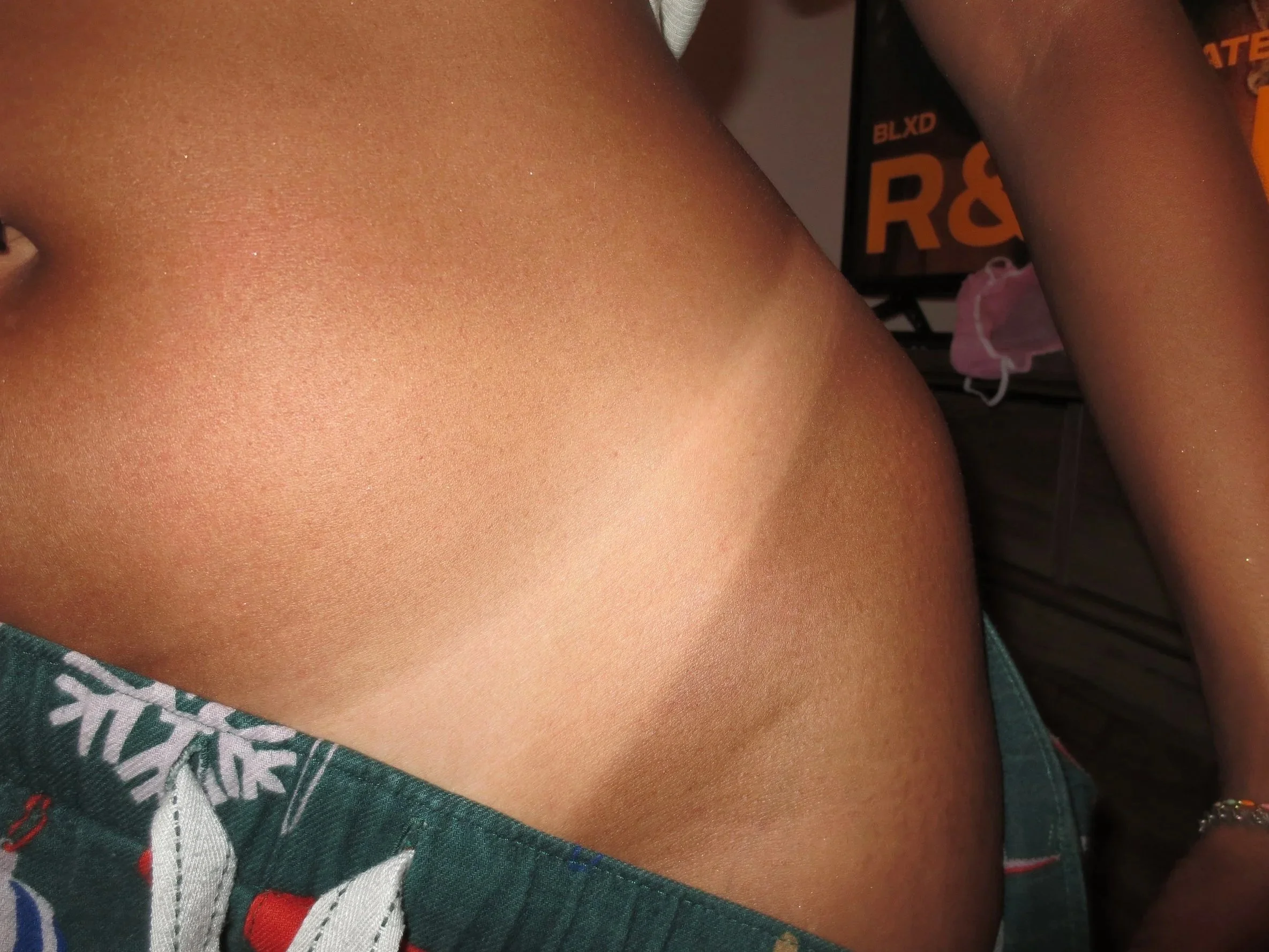 Close-up image of a person's bare shoulder and upper chest, with part of patterned clothing visible at the bottom and a dark background with text.