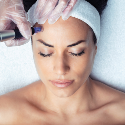Microneedling procedure being done on a woman's face in Colleyville, TX