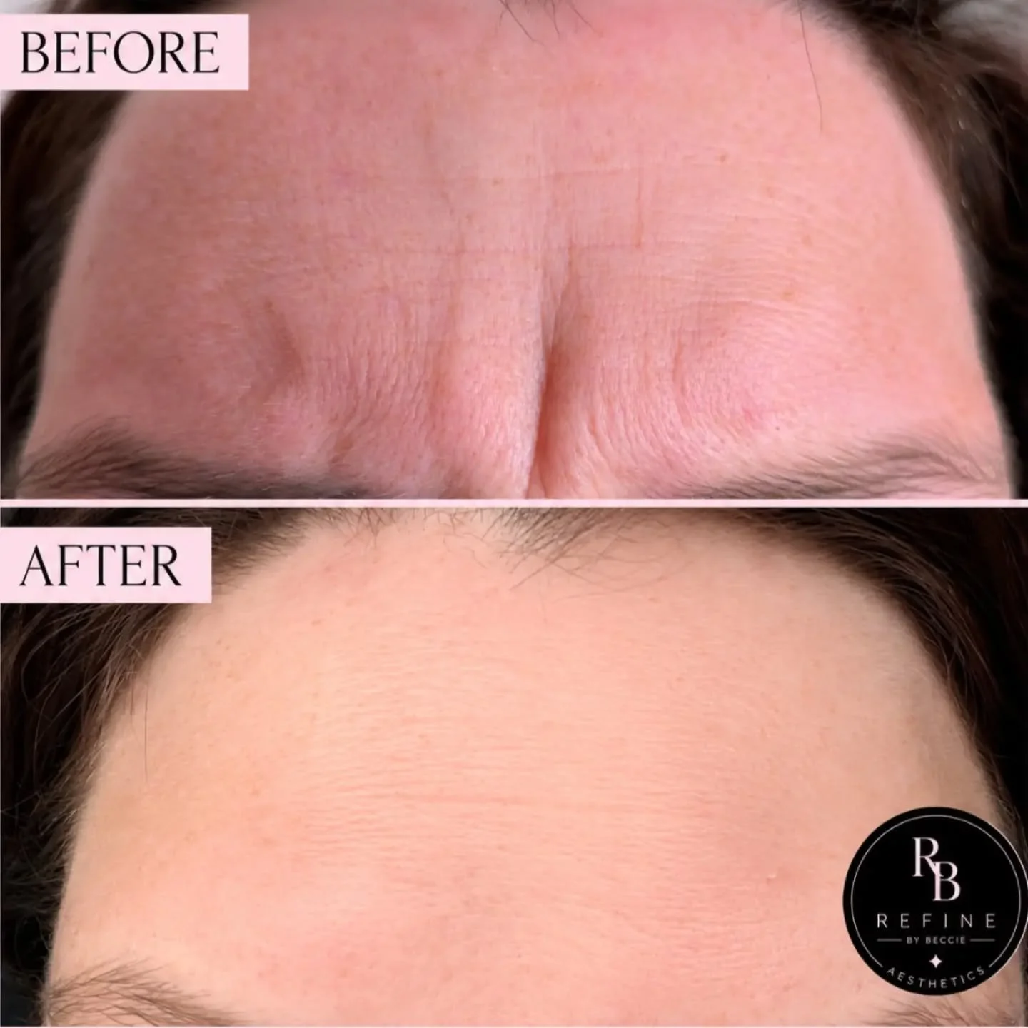Look at that smooth forehead 😍 

#AntiWrinkleTreatment #BeforeAndAfter #AestheticClinic #AestheticPractitioner