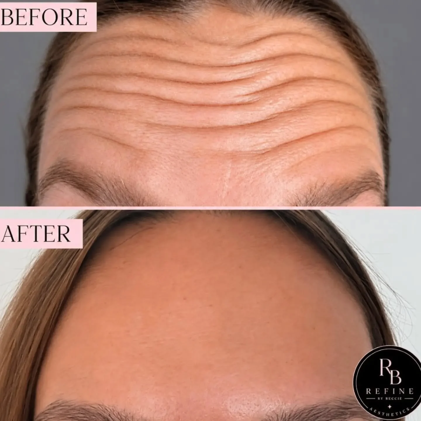 🩷 This lady was desperate to remove her deep frown line and soften those forehead wrinkles. 

I promise you she was frowning in this after picture 🤣 
Not a wrinkle in sight 😍

And how much better does her skin tone look? 

#RefineByBeccie #Aesthet