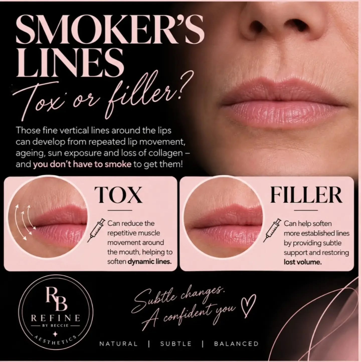 💋 SMOKER&rsquo;S LINES &mdash; TOX OR FILLER?

I&rsquo;ve had a few people ask me about treating smoker&rsquo;s lines recently, so I thought I&rsquo;d explain the difference between tox and filler and how they can be used to help soften the appearan