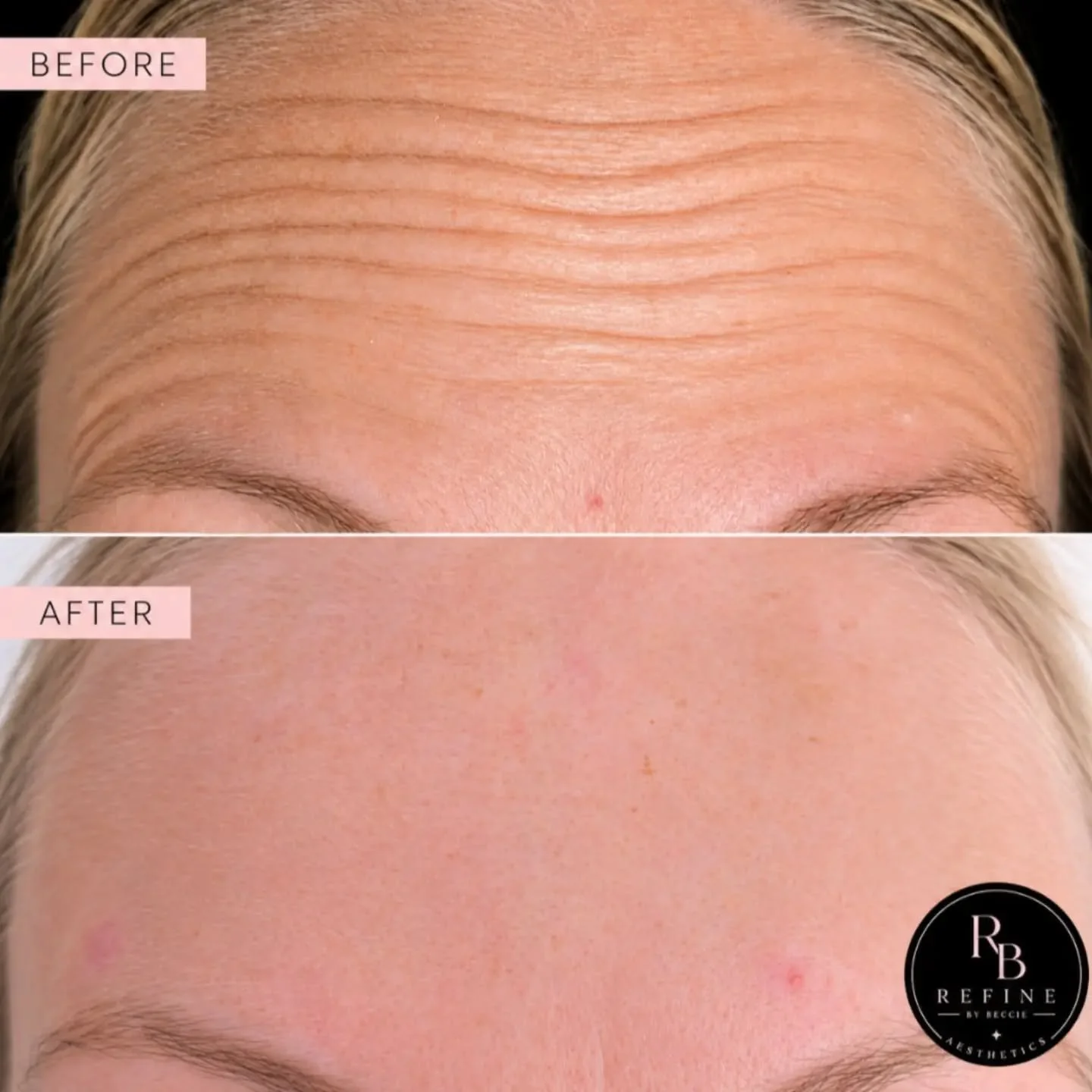🩷 Another lovely client who wanted those lines smoothing out.

Not a frown or wrinkle in sight 😍

🩷DM me to look and feel your best for a wrinkle free Autumn 🧡

#RefineByBeccie #Aesthetics #BeforeAndAfter #AestheticPractitioner  #AntiWrinkle
