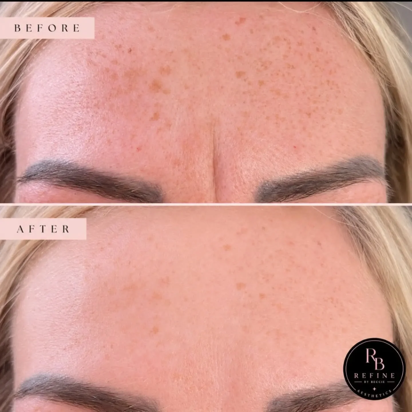 🩷This lady wanted her deep frown line smoothing out to avoid make up sitting in it, and a tan line on holiday.

Not a wrinkle in sight now 😍