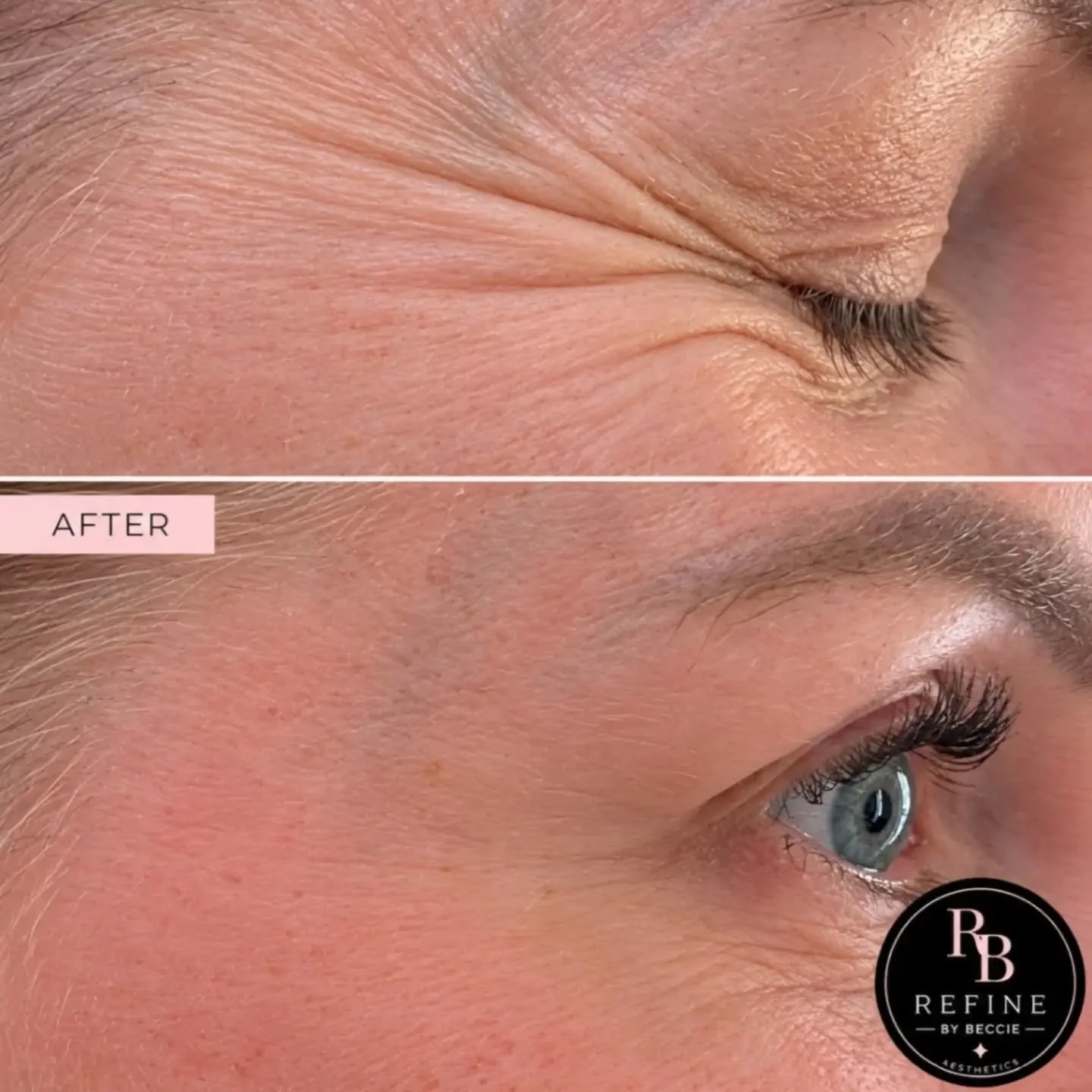 🩷 This lovely client wanted all her lines softening especially  the frown crease. 

They have softened lovely while still keeping natural movement 🩷

If you are considering Anti-Wrinkle treatment, please get in touch for a consultation, we can talk