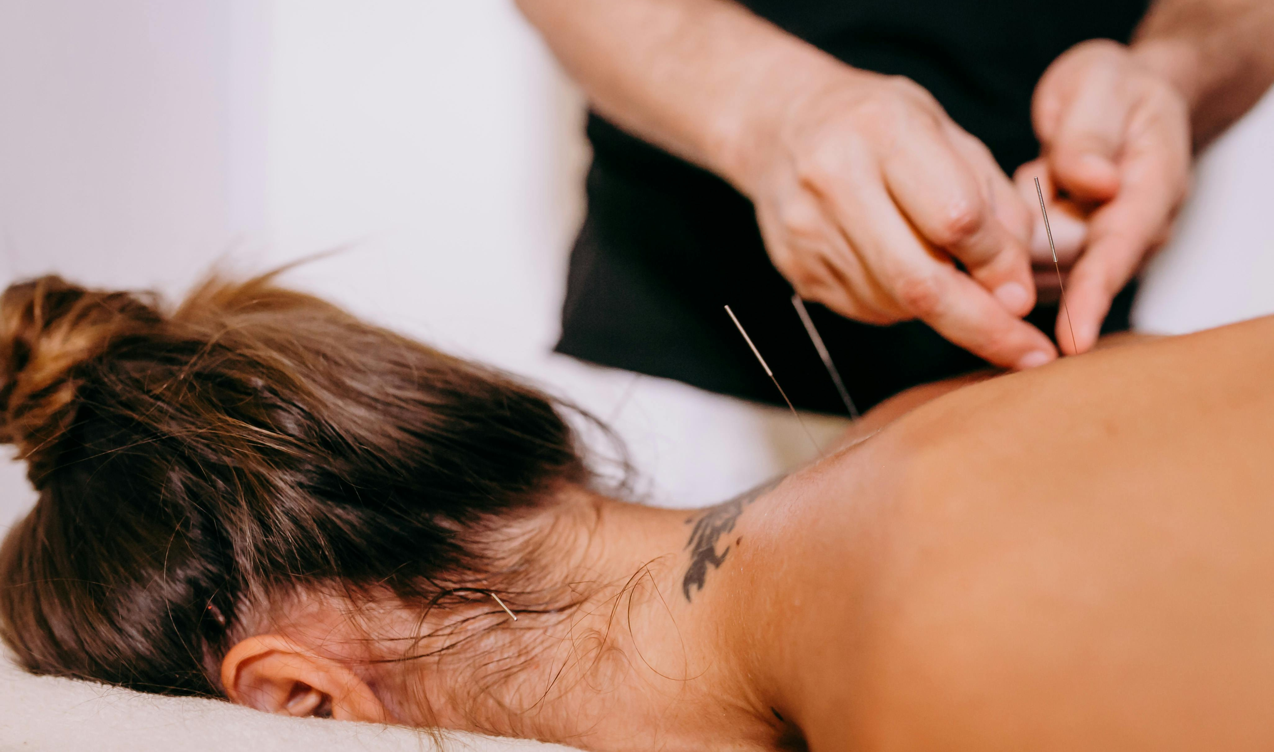An acupuncture session with acupuncture needles inserted into a person's back while lying face down.