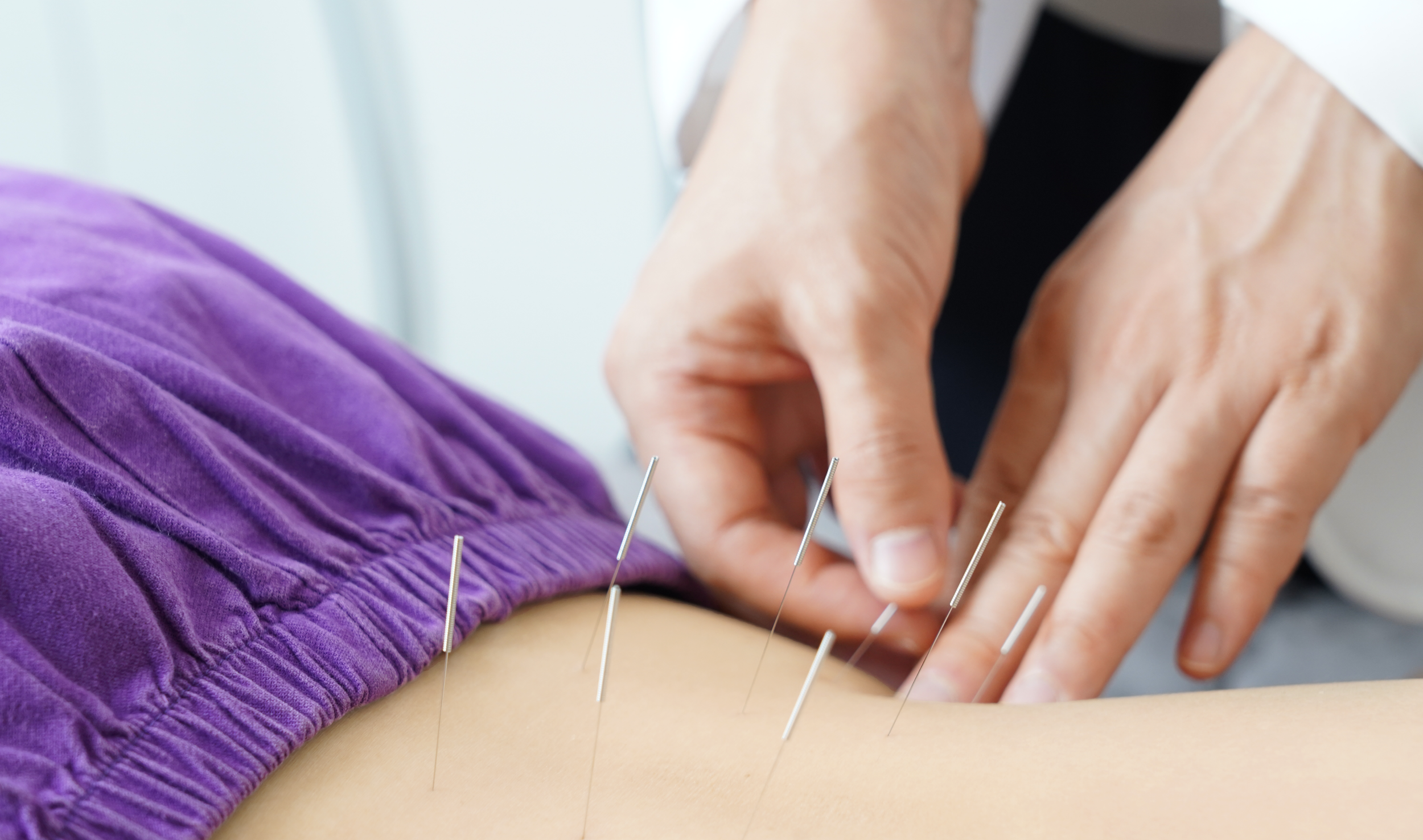 Person undergoing acupuncture treatment with thin needles inserted into their arm, wearing purple clothing.