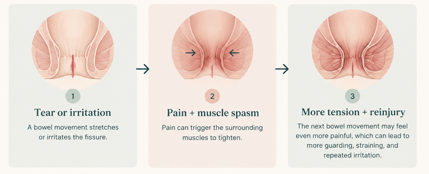 Three-step diagram showing the anal fissure pain cycle: irritation, muscle spasm, and increased tension or reinjury.