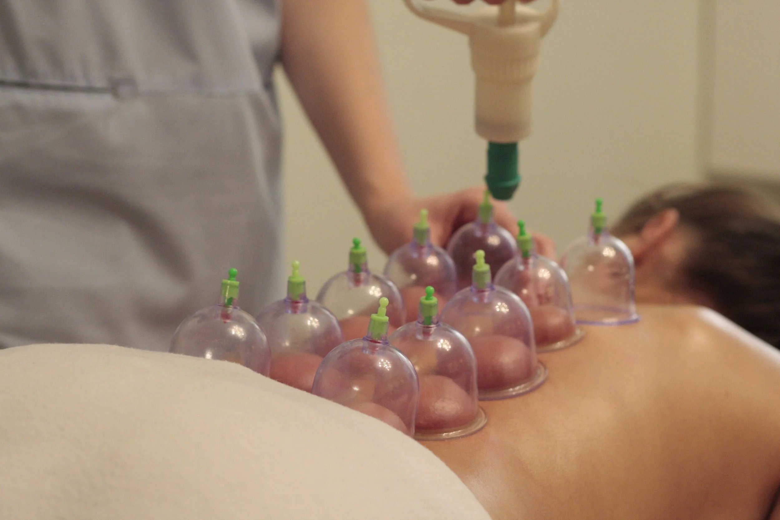 Person receiving a cupping therapy session with glass cups on their back.
