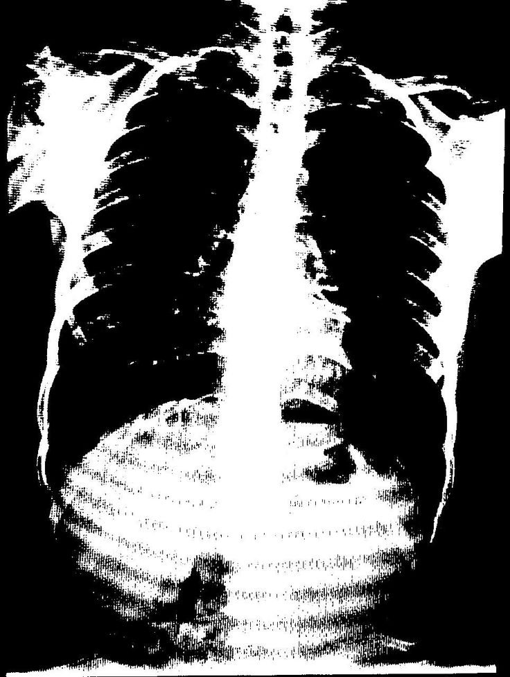 A high-contrast, black-and-white image of a human chest X-ray showing lungs and ribs.