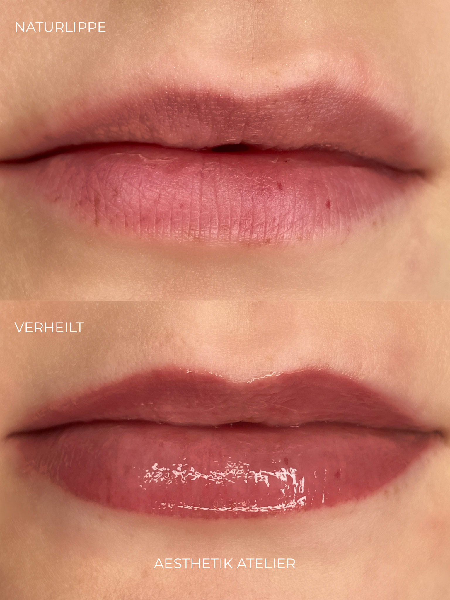 Nahaufnahme von menschlichen Lippen, teilweise geöffnet, mit glänzendem Lippenstift, Text auf dem Bild: "NATURLIPPE" oben links, "VERHEILT" unten links, "AESTHETIK ATELIER" unten Mitte.