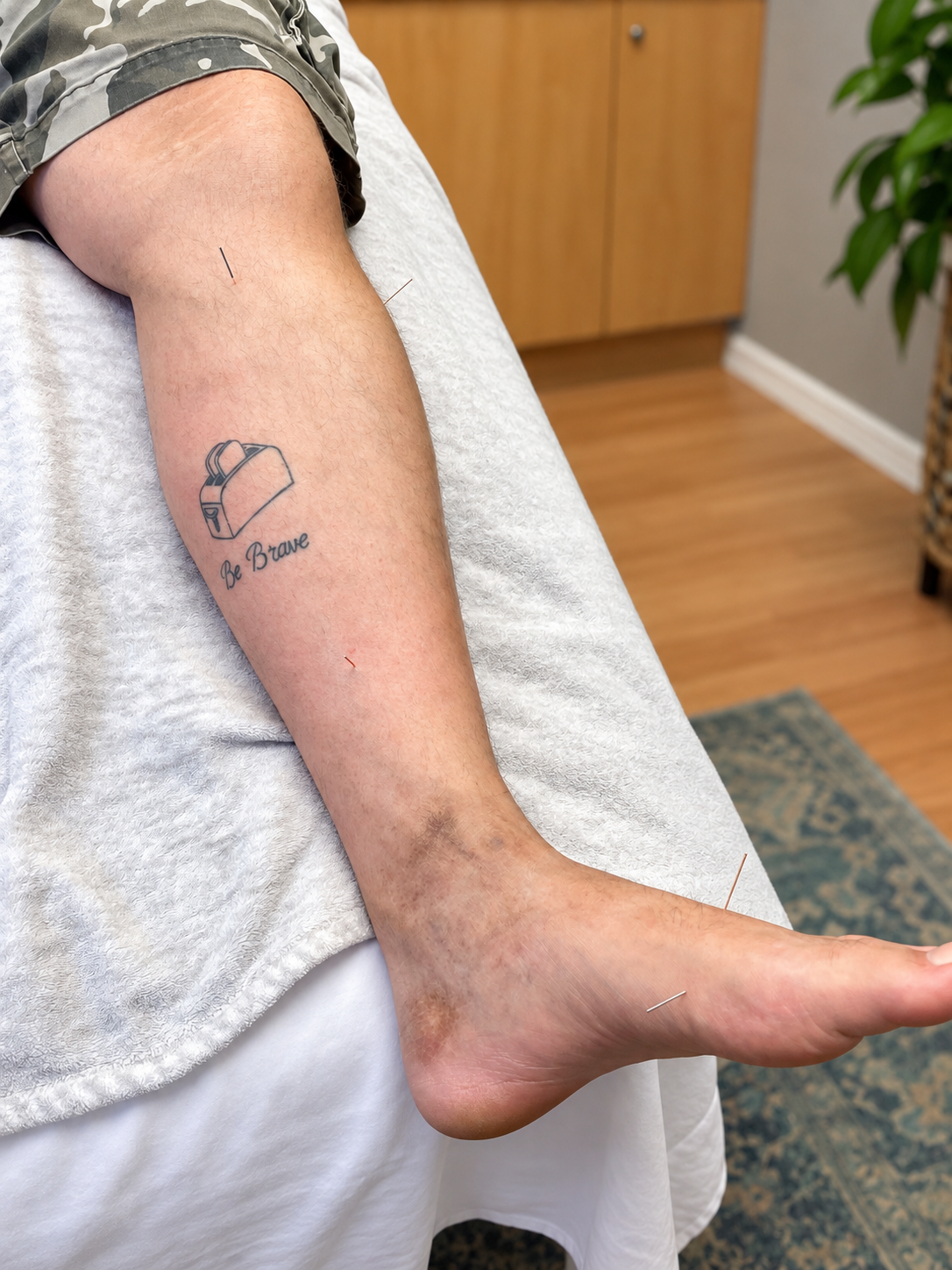 Acupuncture needles in the lower leg and foot during a peripheral neuropathy treatment in Waterloo