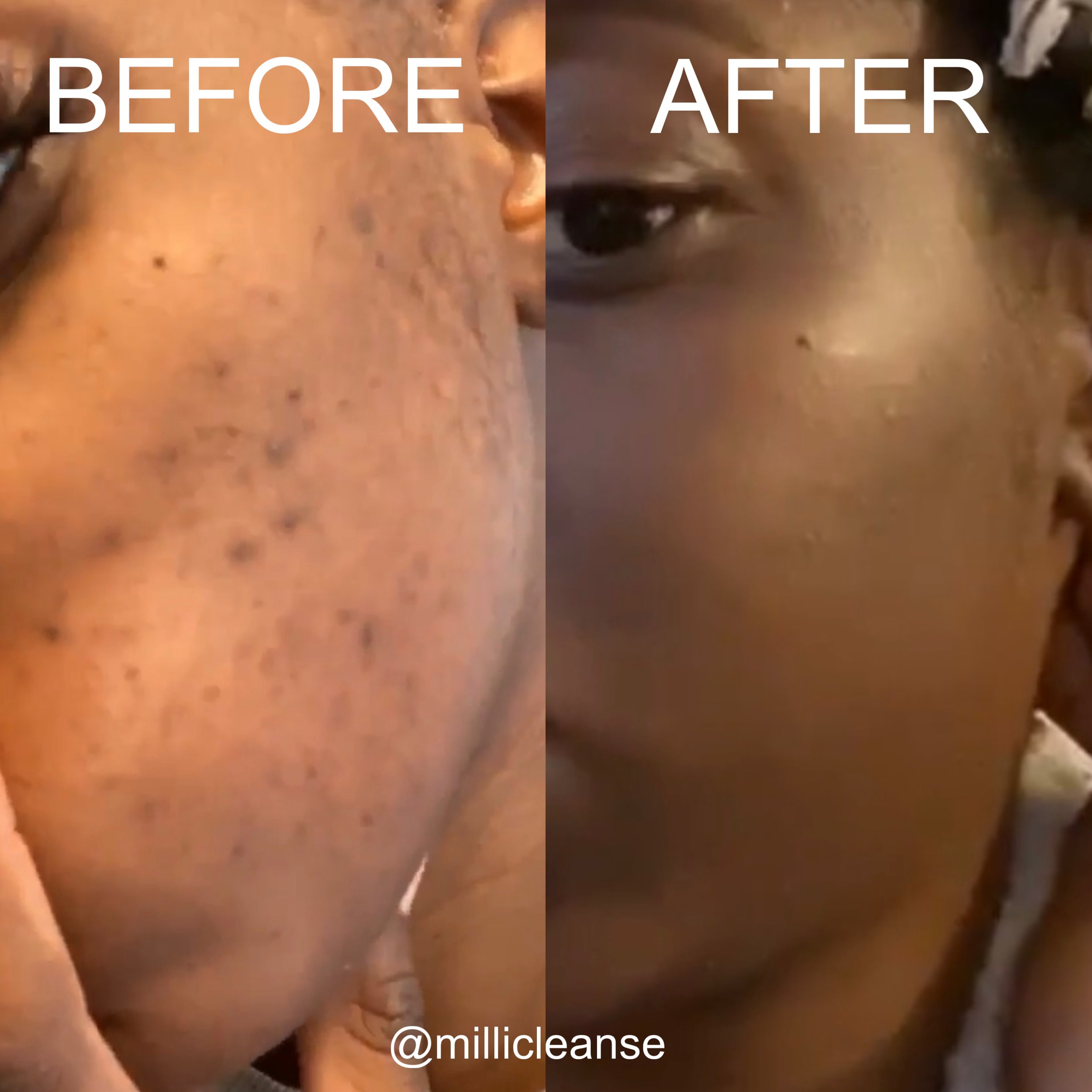 Before and after photos of facial hyperpigmentation showing changes in the appearance of dark spots and uneven skin tone.